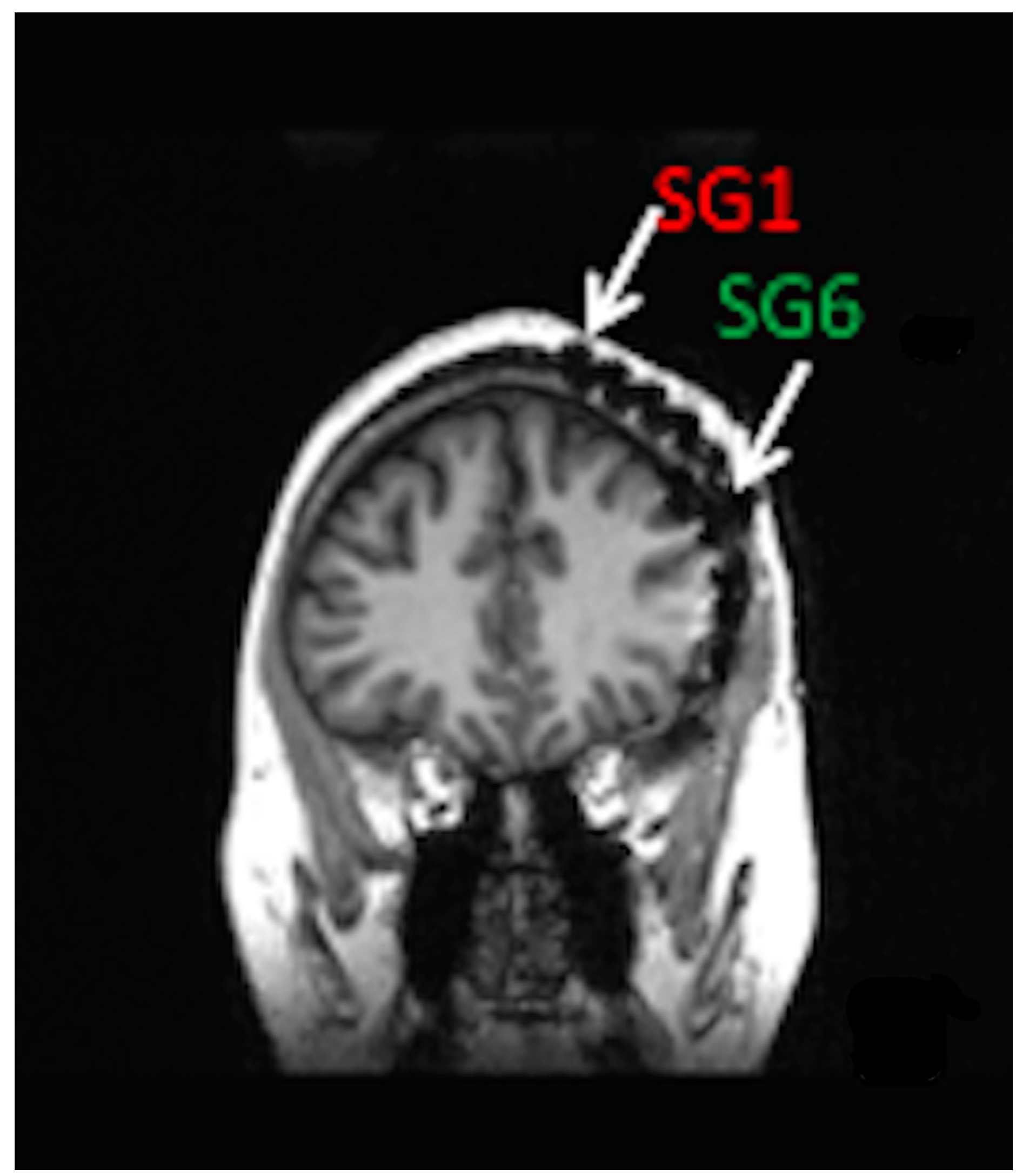 eeg brain scan