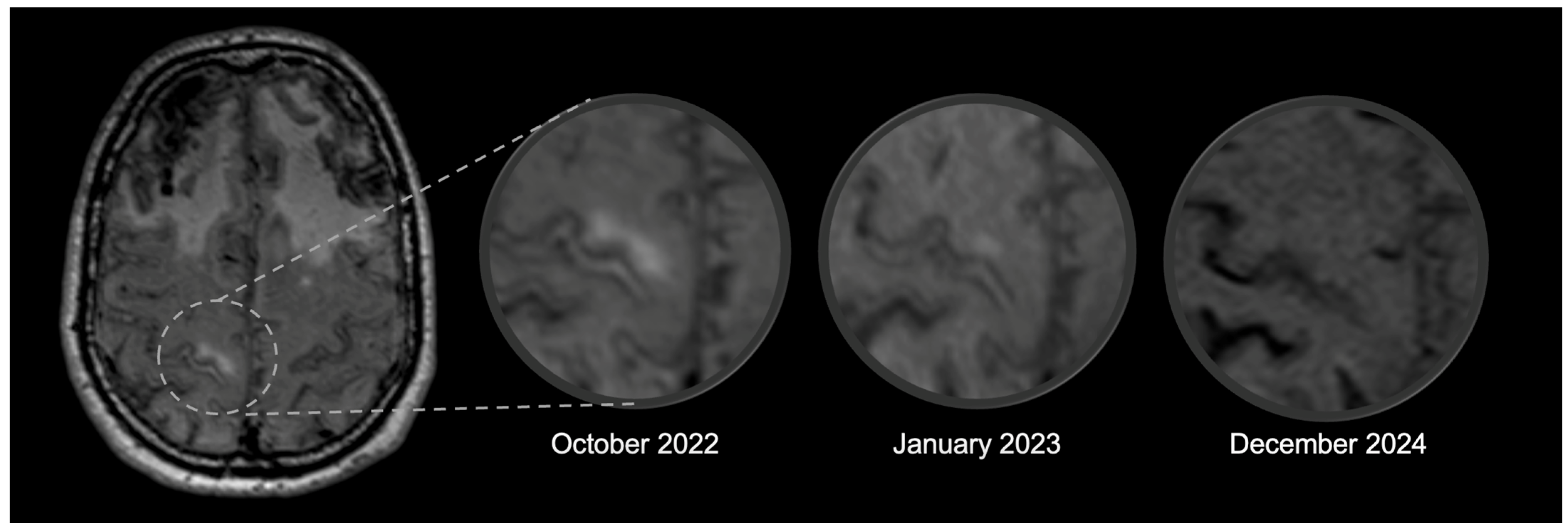 The Inflammatory Side of Iatrogenic Cerebral Amyloid Angiopathy ...