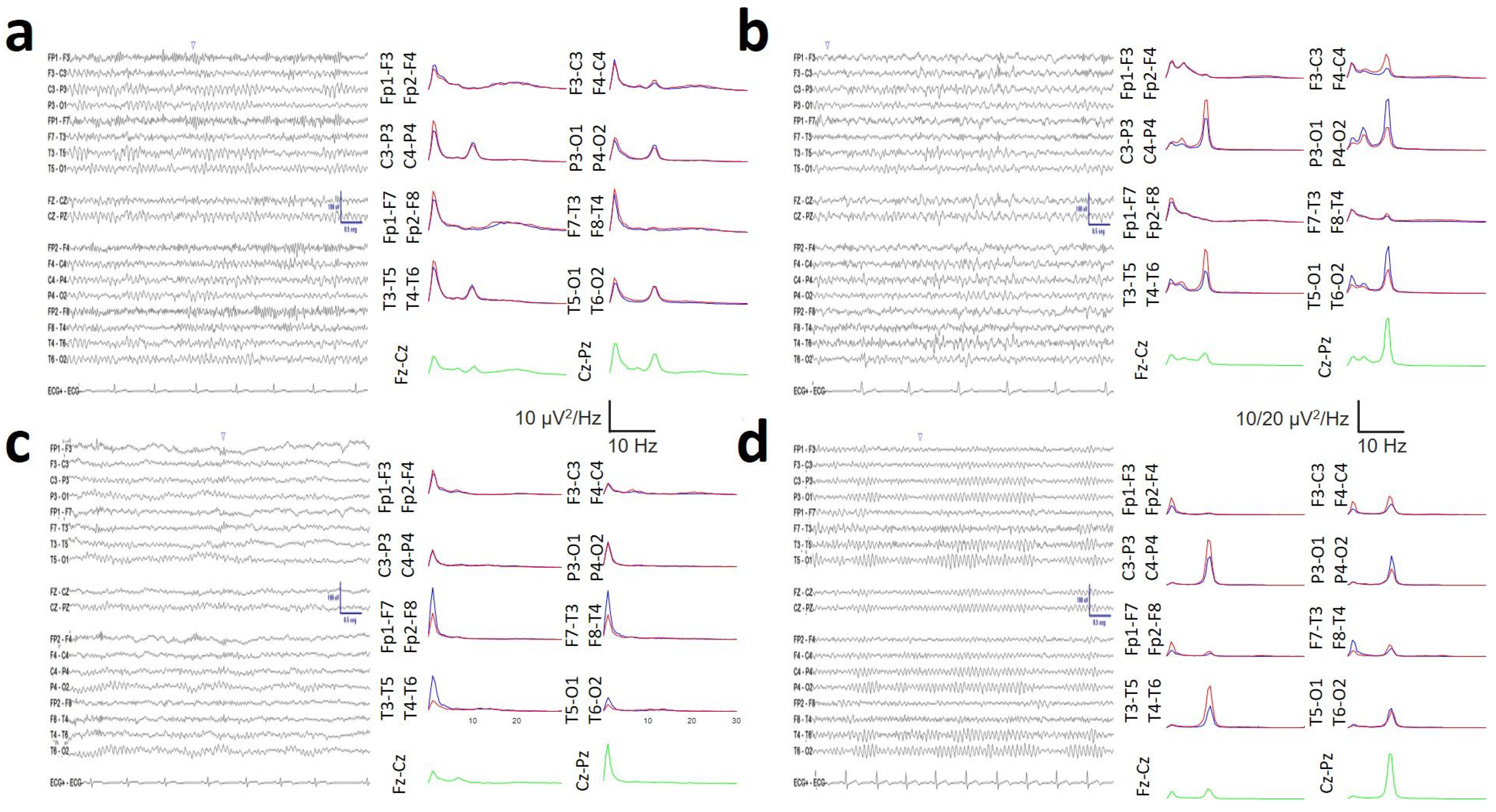 comparison-of-resting-state-eeg-and-synchronization-between-young