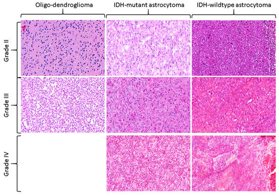 Glioma Grading via Analysis of Digital Pathology Images Using Machine ...