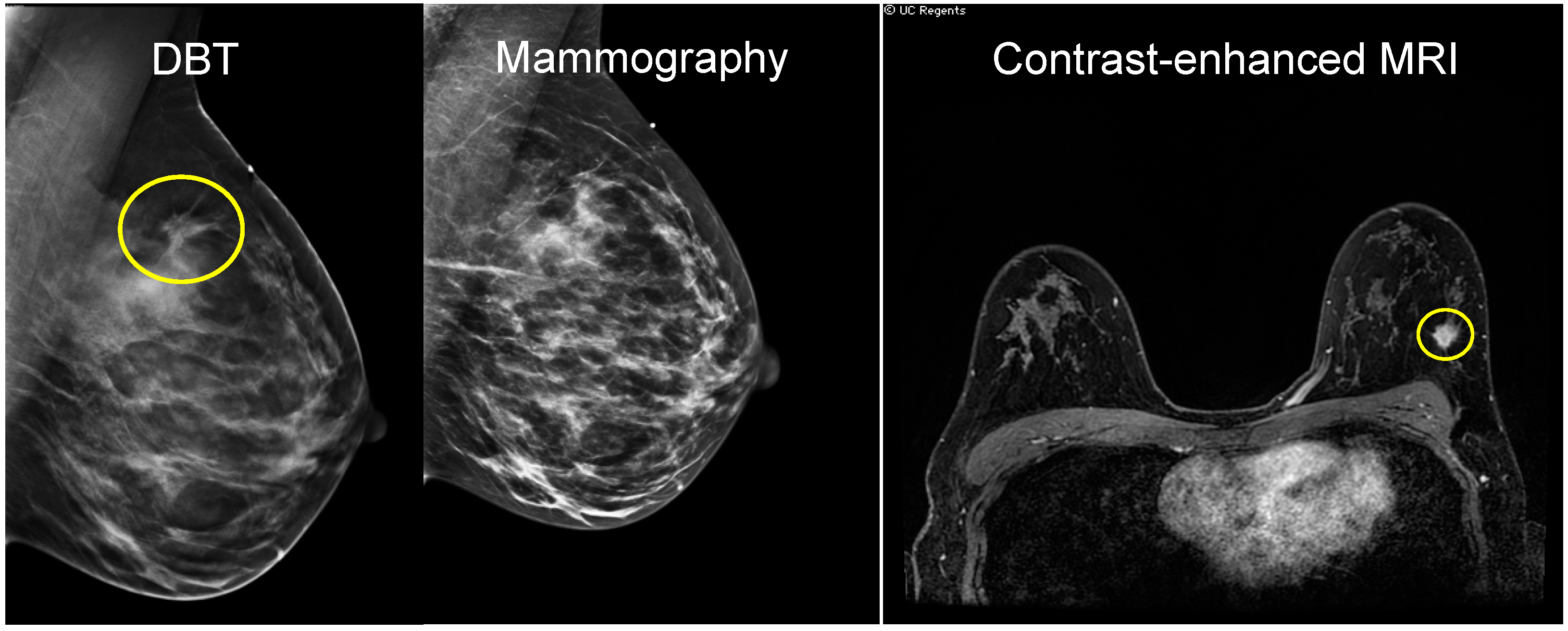 breast cancer imaging thesis