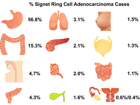 POR | Clinicopathological and Molecular Characteristics of Colorectal Signet  Ring Cell Carcinoma: A Review