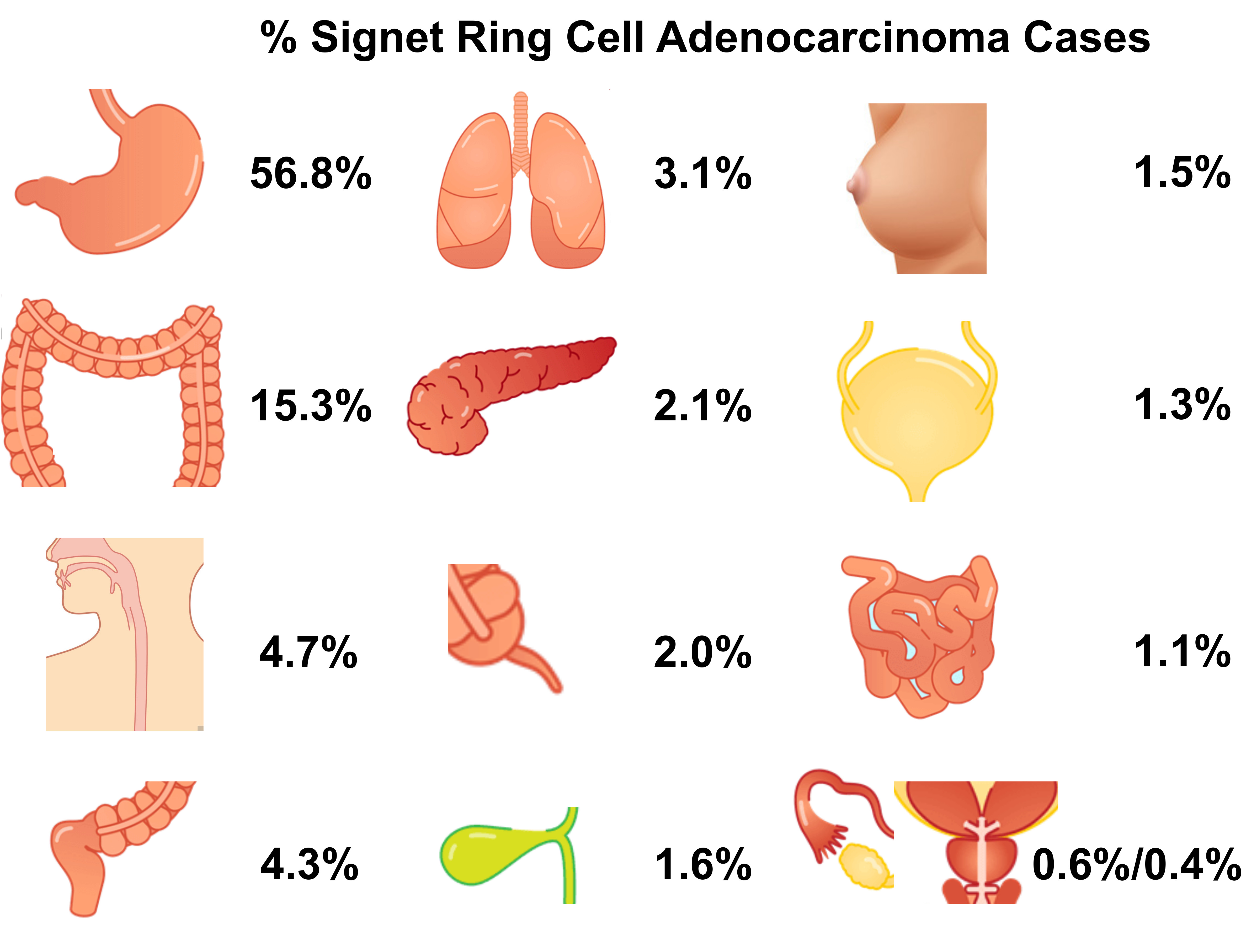 Composite signet-ring cell/neuroendocrine carcinoma of the stomach with a  metastatic neuroendocrine carcinoma component: a better prognosis entity |  Diagnostic Pathology | Full Text