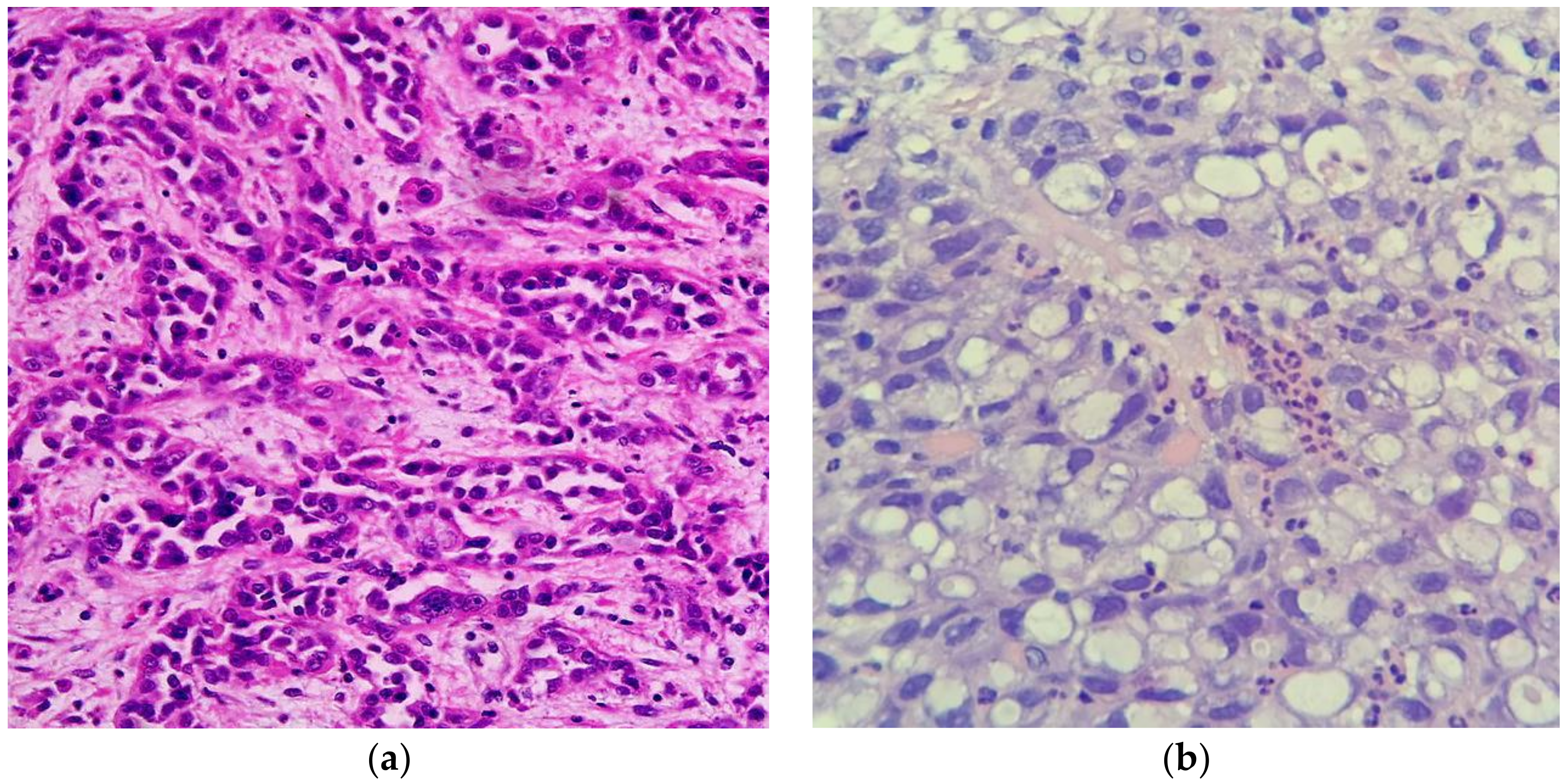 PDF) Colon signet ring cell carcinoma metastatic to breast