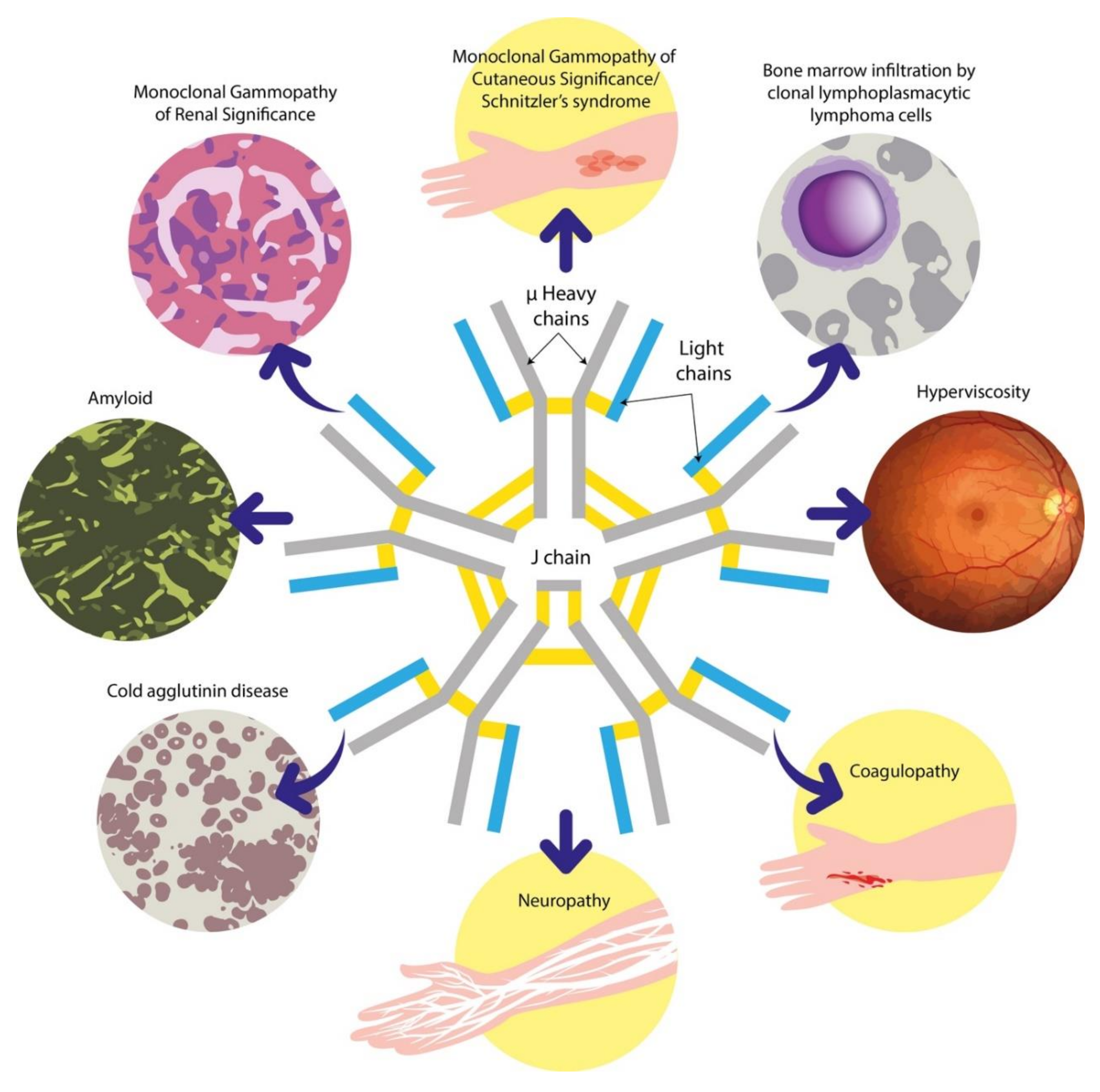 Mier technisch operatie Cancers | Free Full-Text | Immunoglobulin M Paraproteinaemias