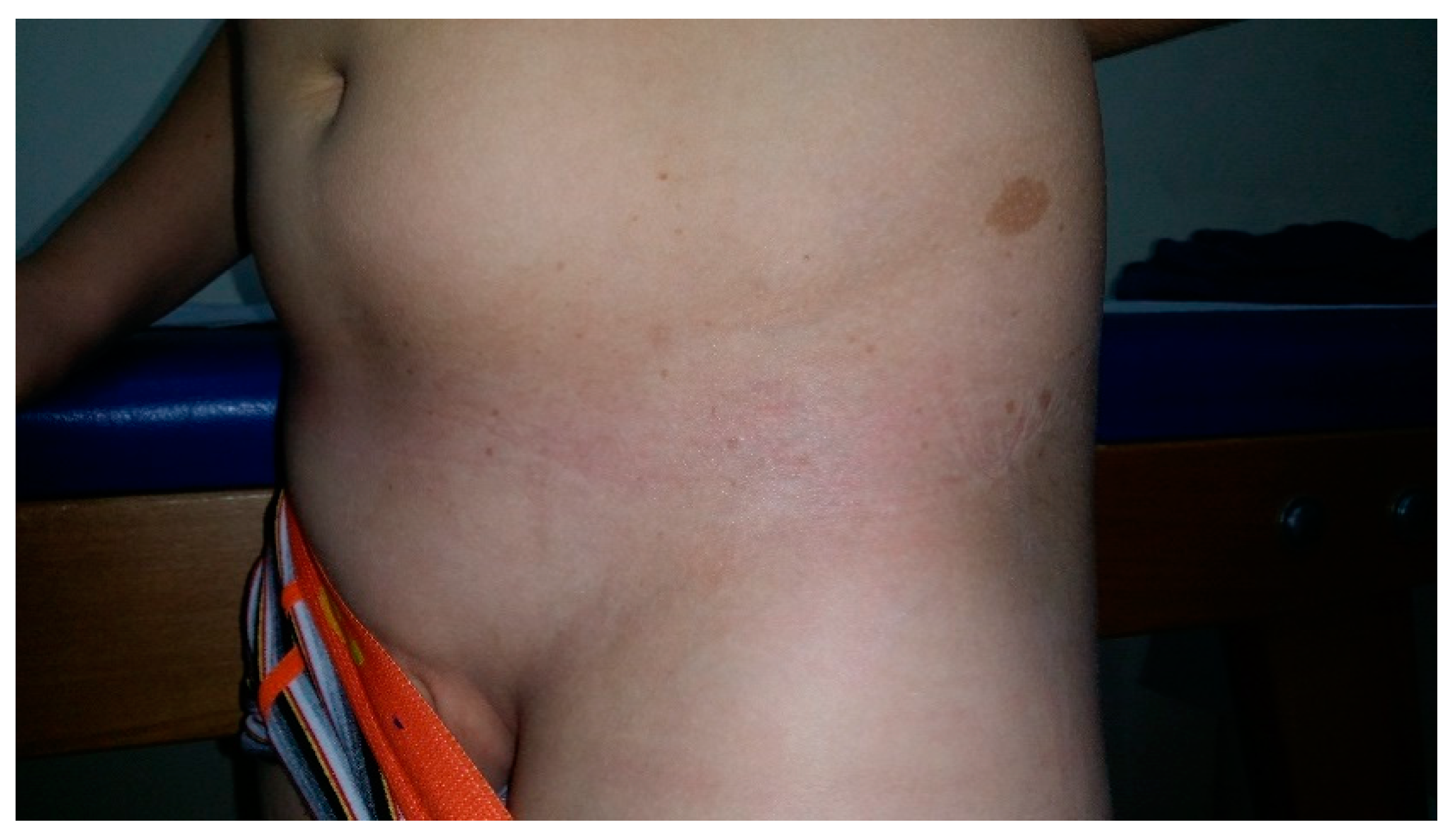 I have a variety of spots/marks on my upper torso/under breast area. Any  insight? : r/Dermatology