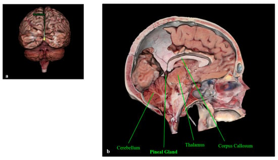 Cancers | Free Full-Text | Pineal Gland Tumors: A Review