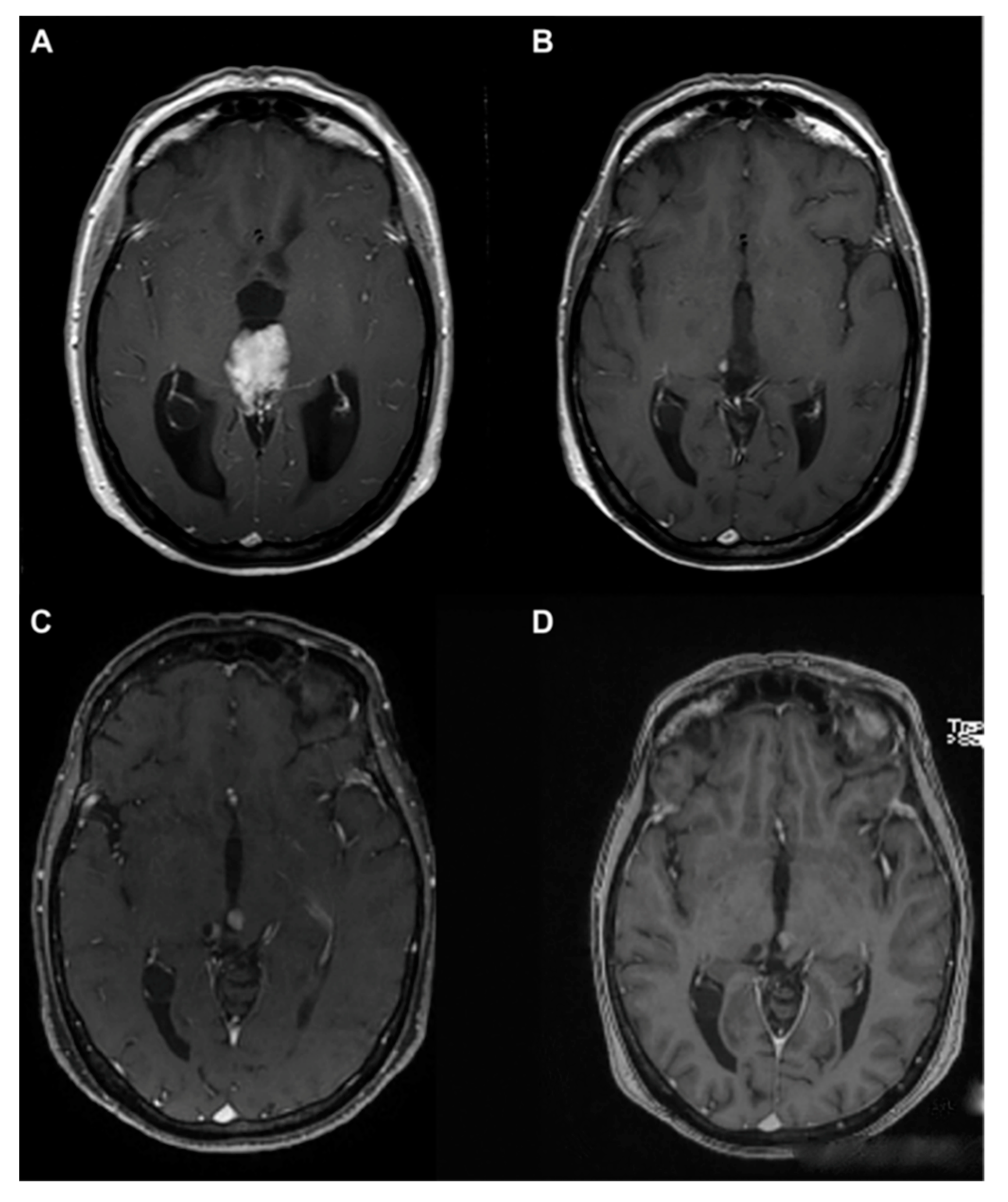 Cancers | Free Full-Text | Pineal Gland Tumors: A Review