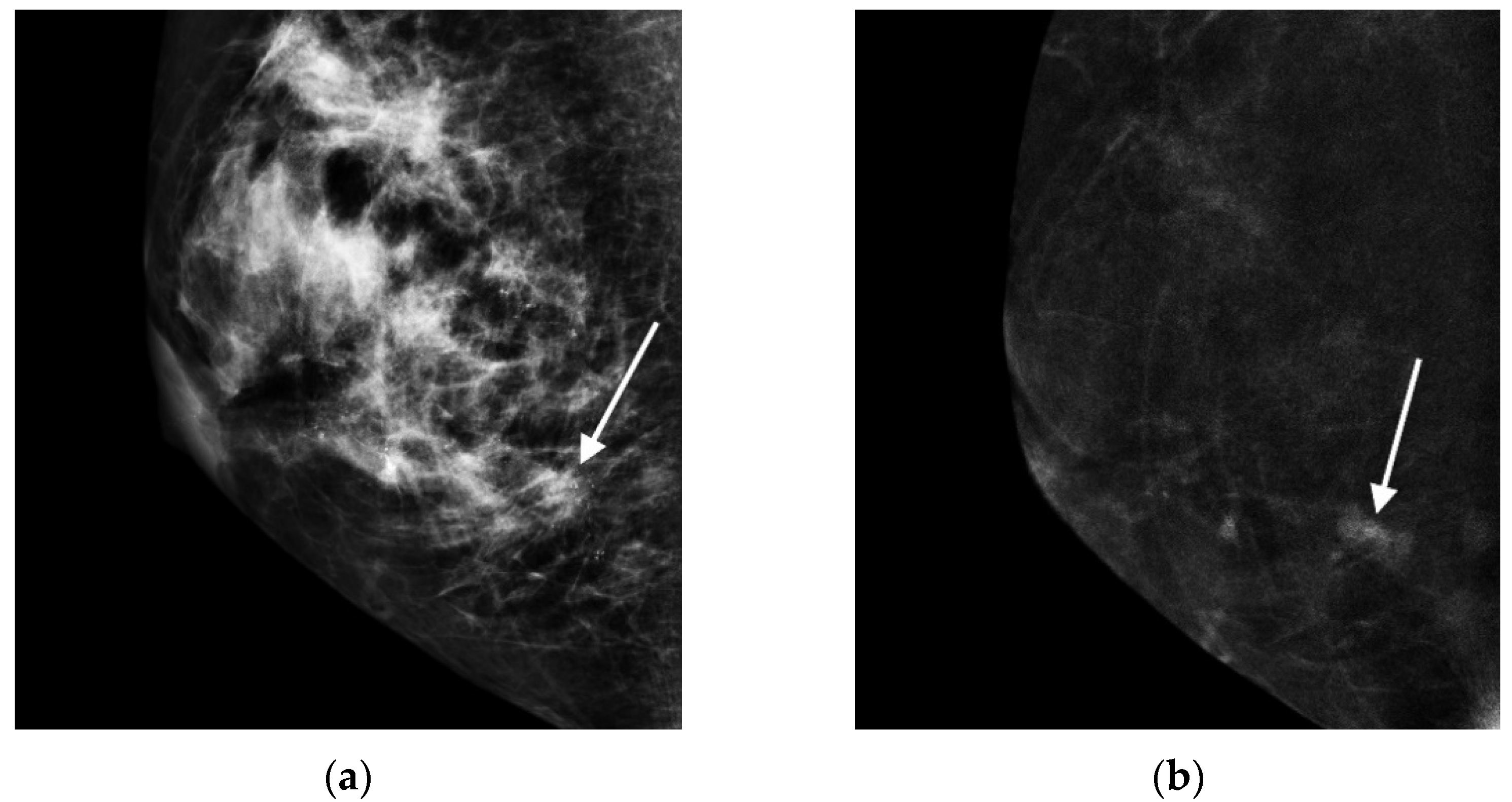 Cancers Free Full Text Contrast Enhanced Mammographic Features Of