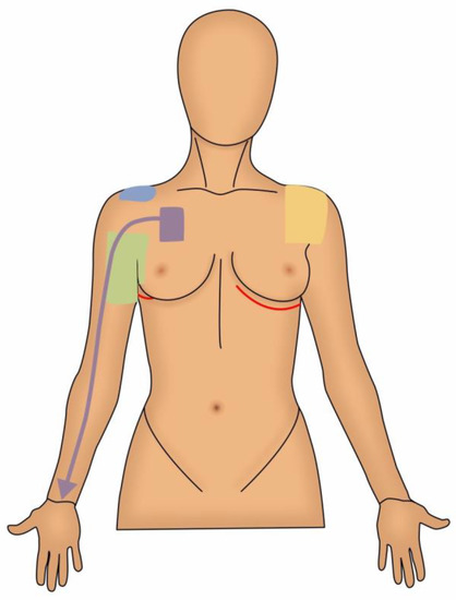 Top 3 Musculoskeletal Side Effects of Breast Cancer Treatment