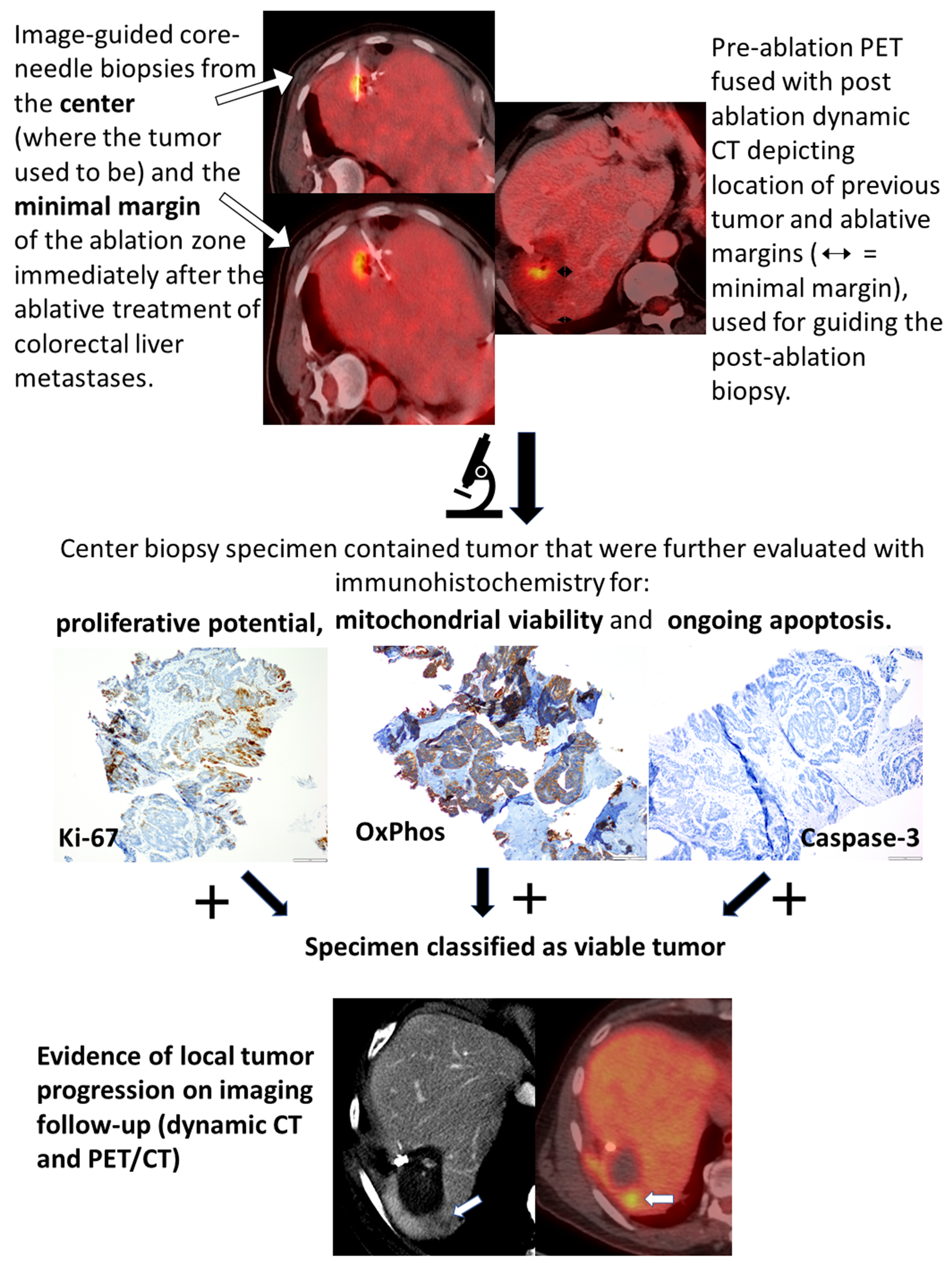 Cancers Free Full-Text Biopsy and Margins Optimize Outcomes after Thermal Ablation of Colorectal Liver Metastases photo