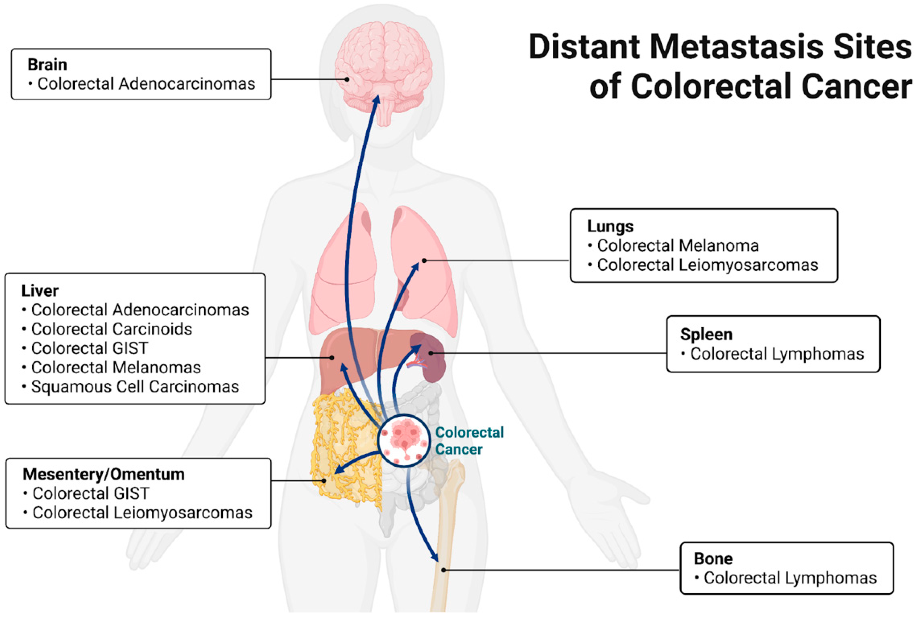 Cancers Free Full-Text Bacterial Involvement in Progression and Metastasis of Colorectal Neoplasia image pic