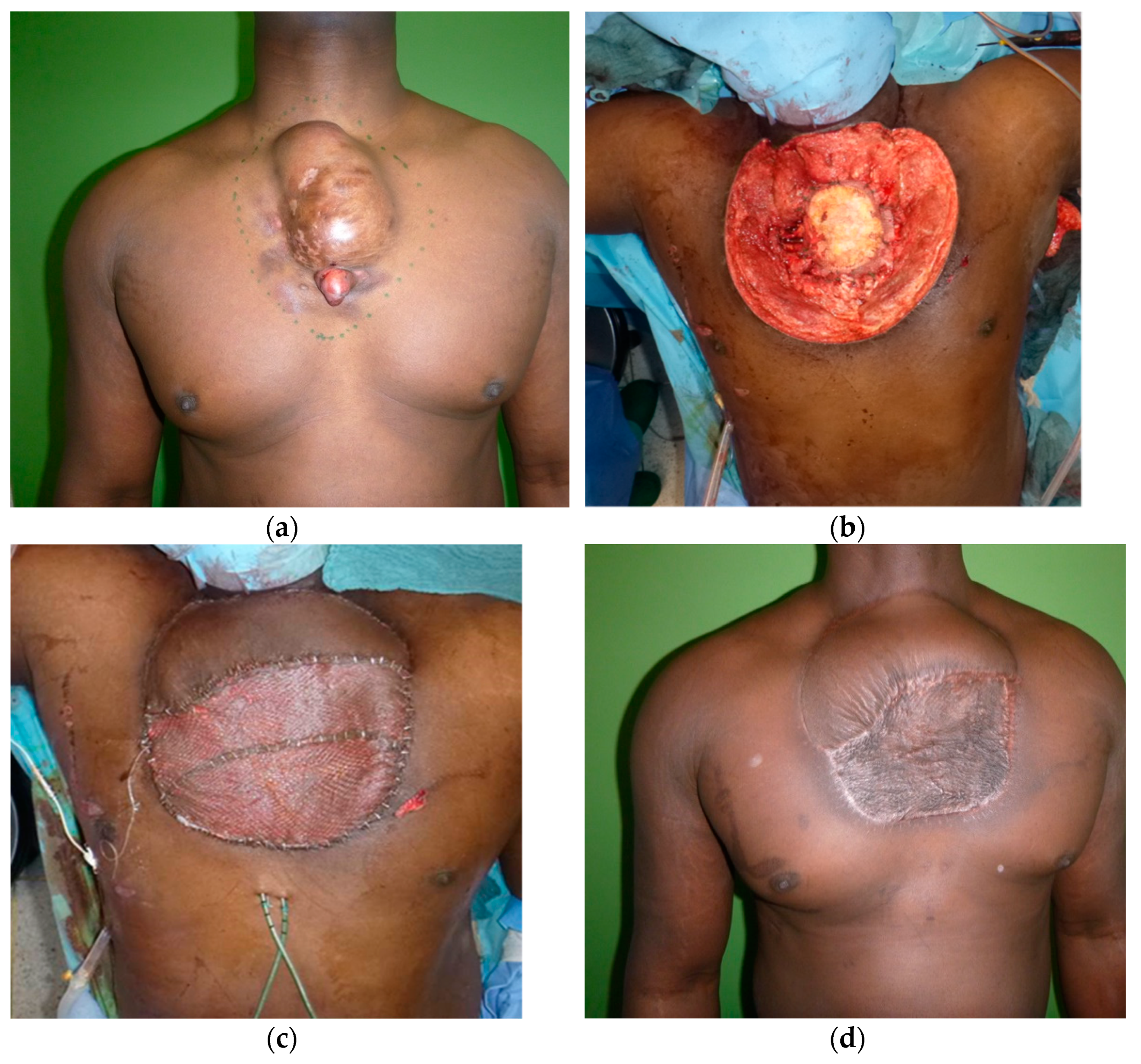 Widespread Tender Hemorrhagic Patches on the Breast