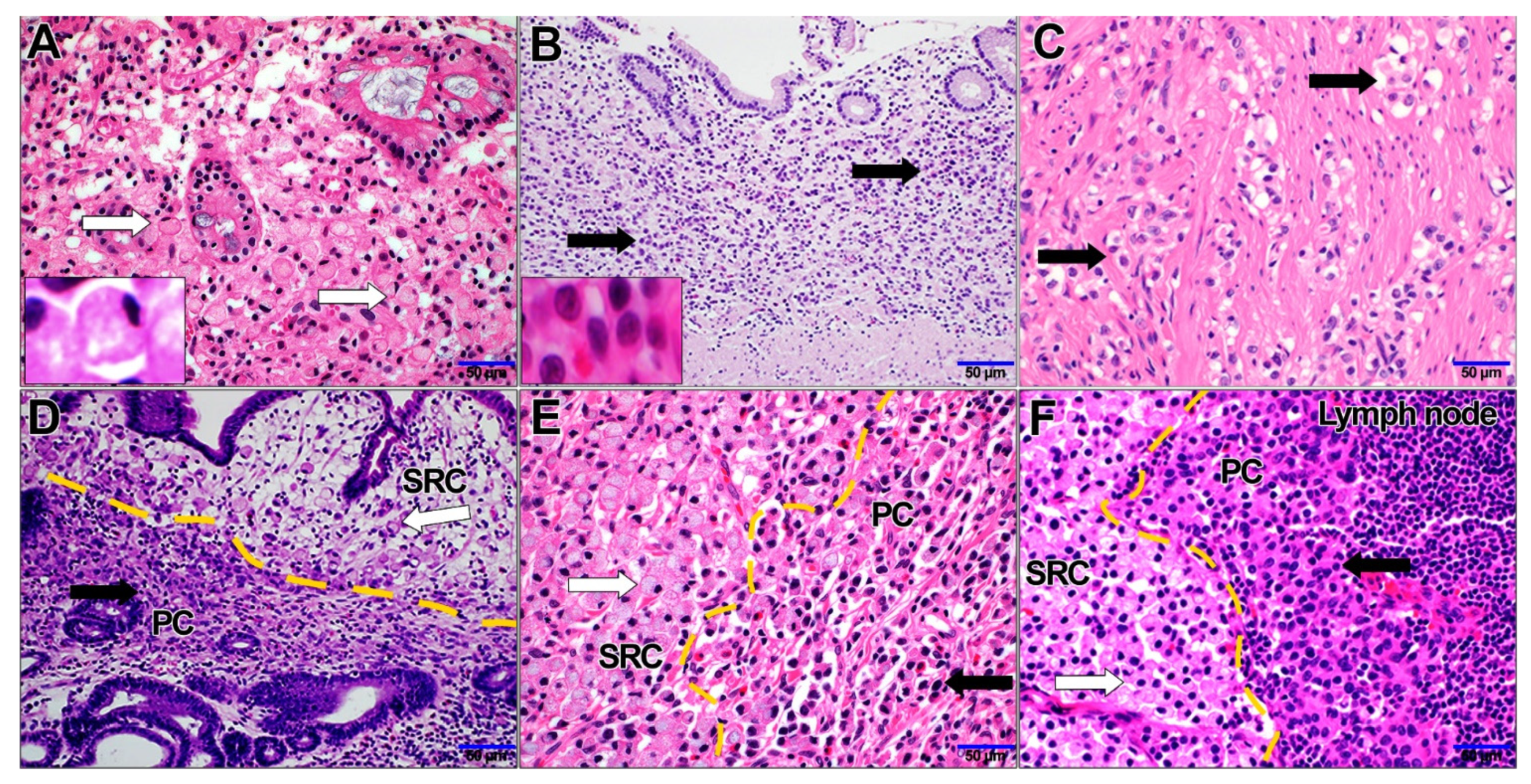 Metastatic Tumors - Metastatic gastric signet ring cell carcinoma (cell  block). - IMAGE ATLAS