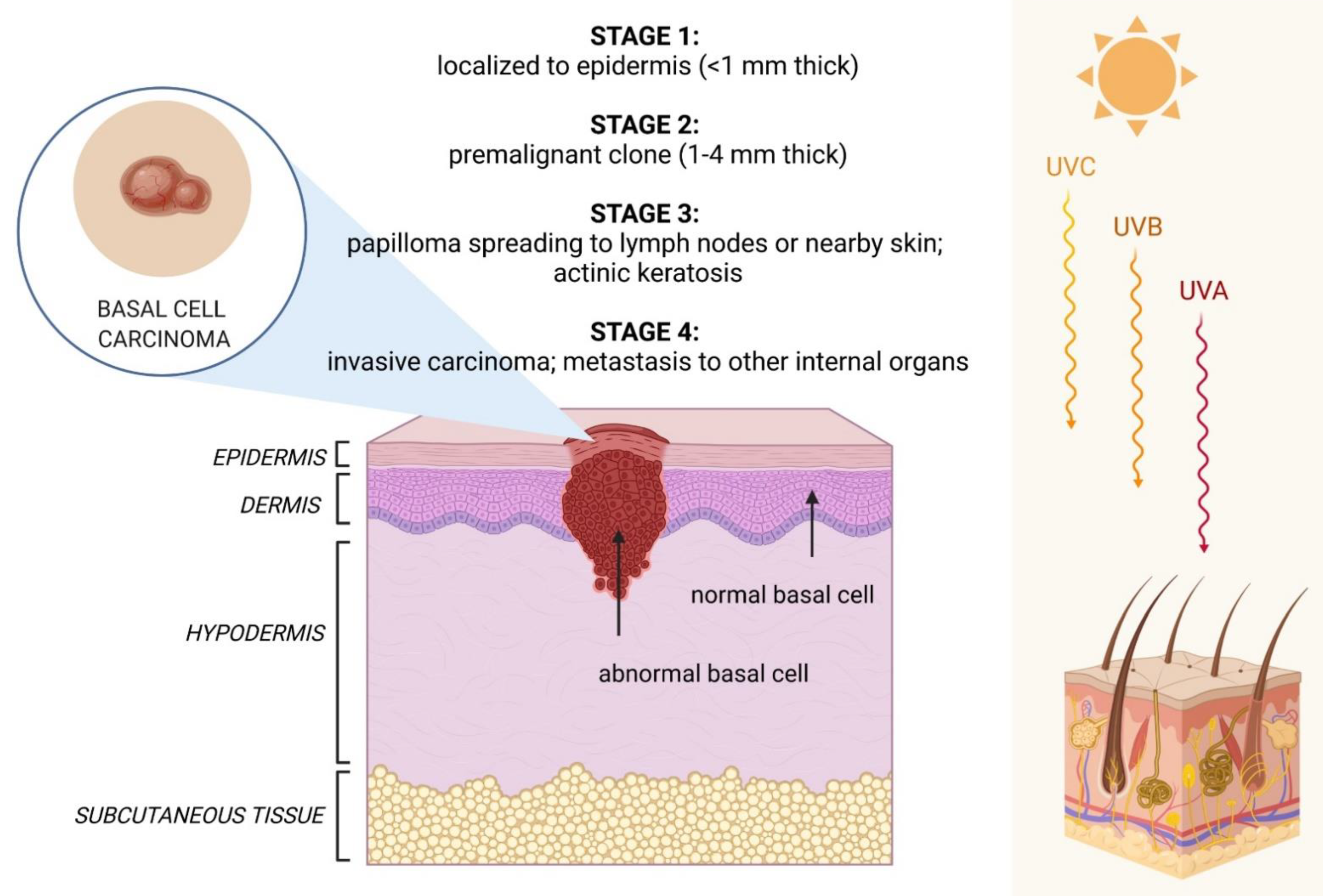 Basal Cell Carcinoma Stages Pictures Guide Basal Cell Carcinoma Stages Pictures Guide