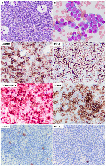 Cancers Free Full Text Immunophenotypic And Molecular Features Of Acute Myeloid Leukemia 1643