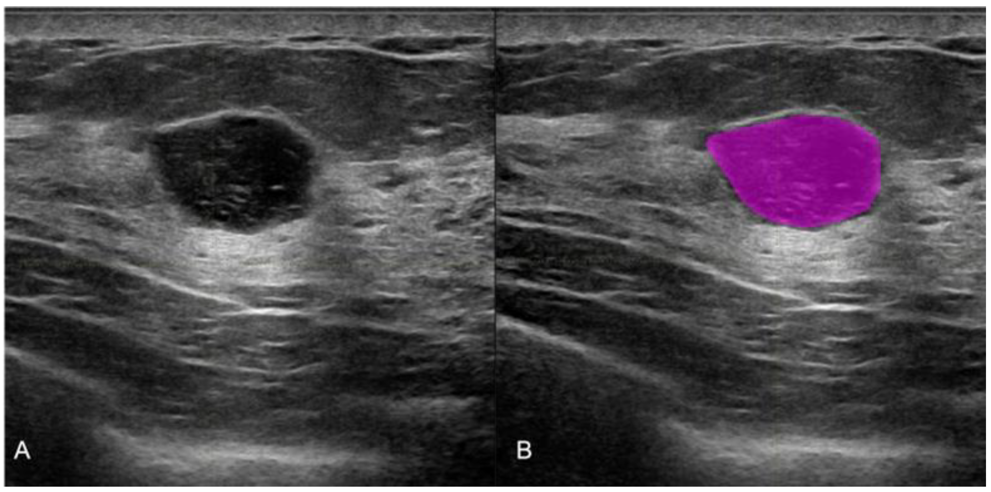 Breast Cancer Malignant Ultrasound Images