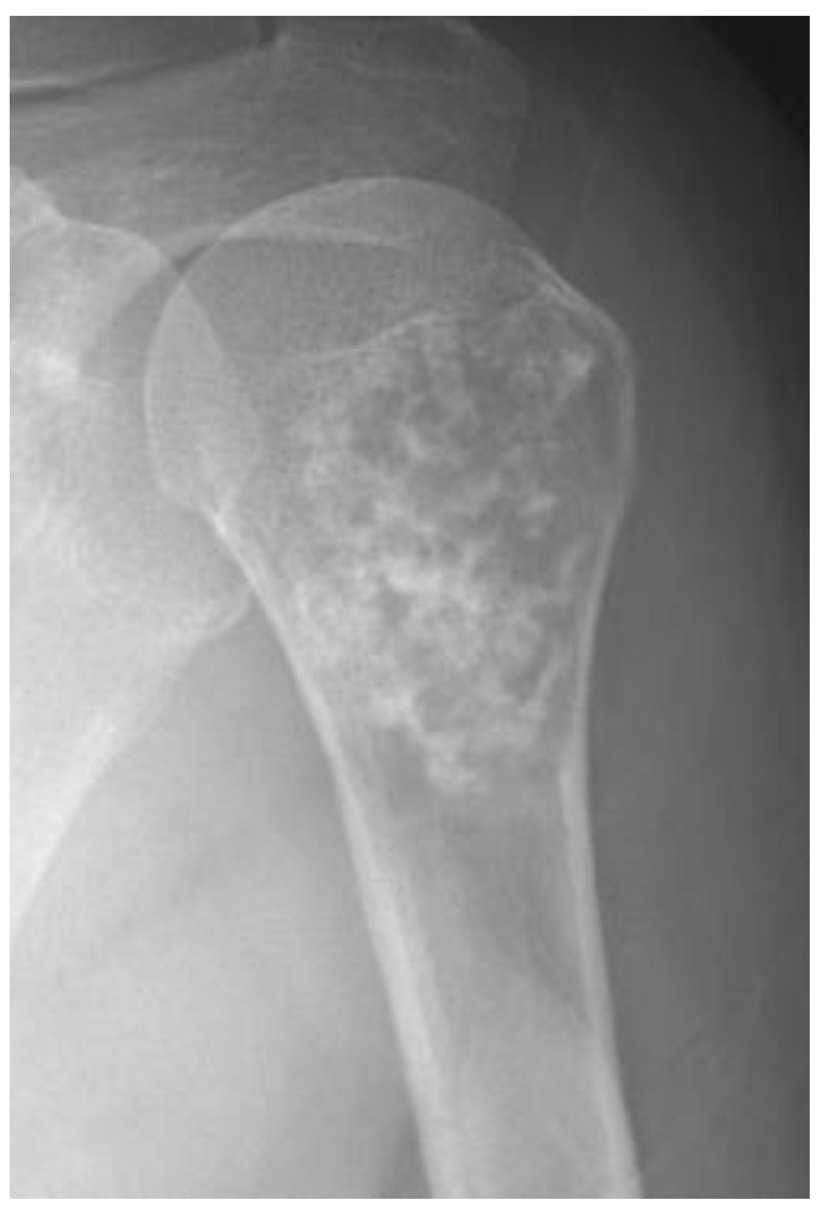 chondroma in knee x ray