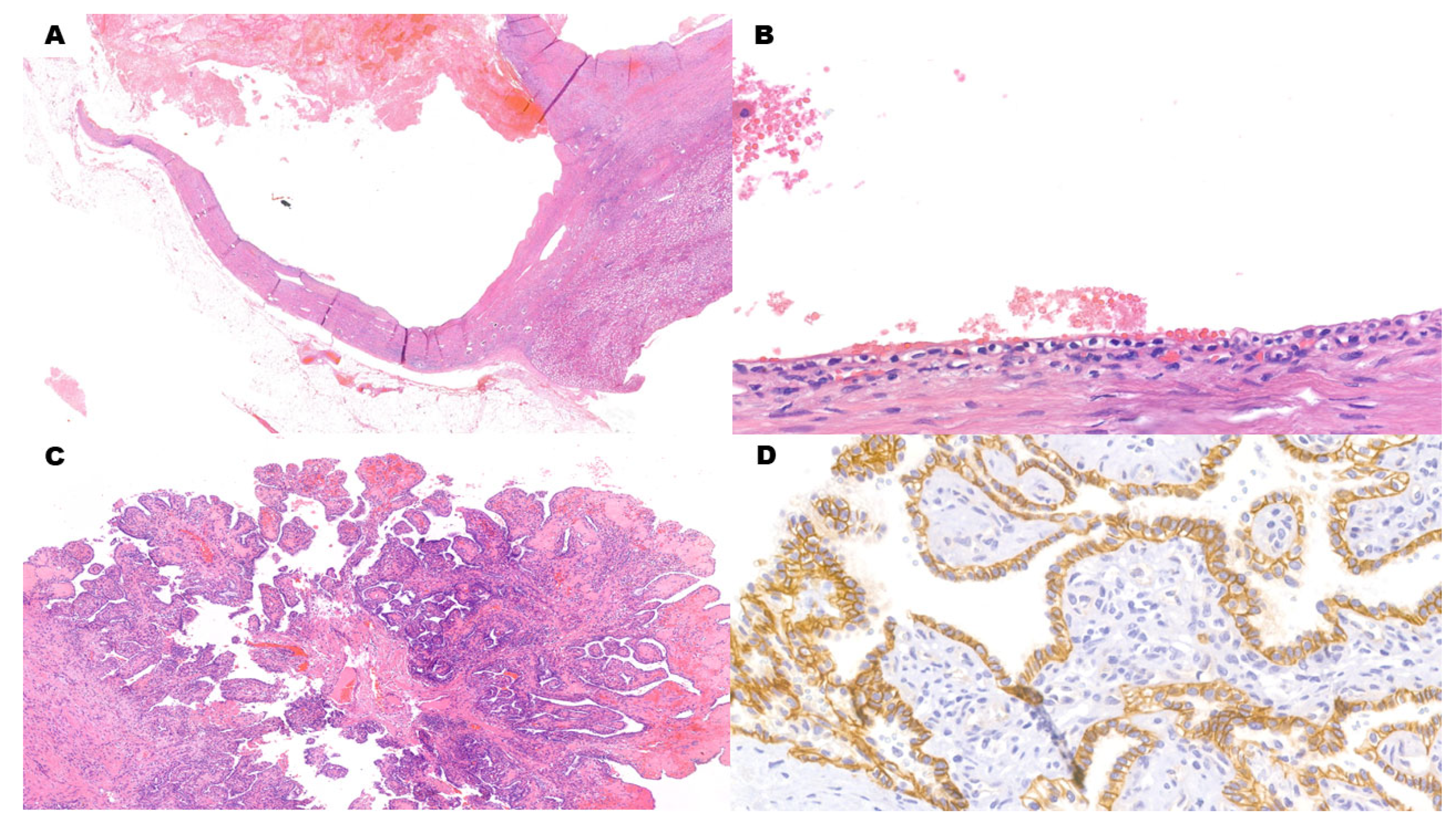 RENAL CELL CARCINOMA- CLEAR CELL TYPE - Pathology Made Simple