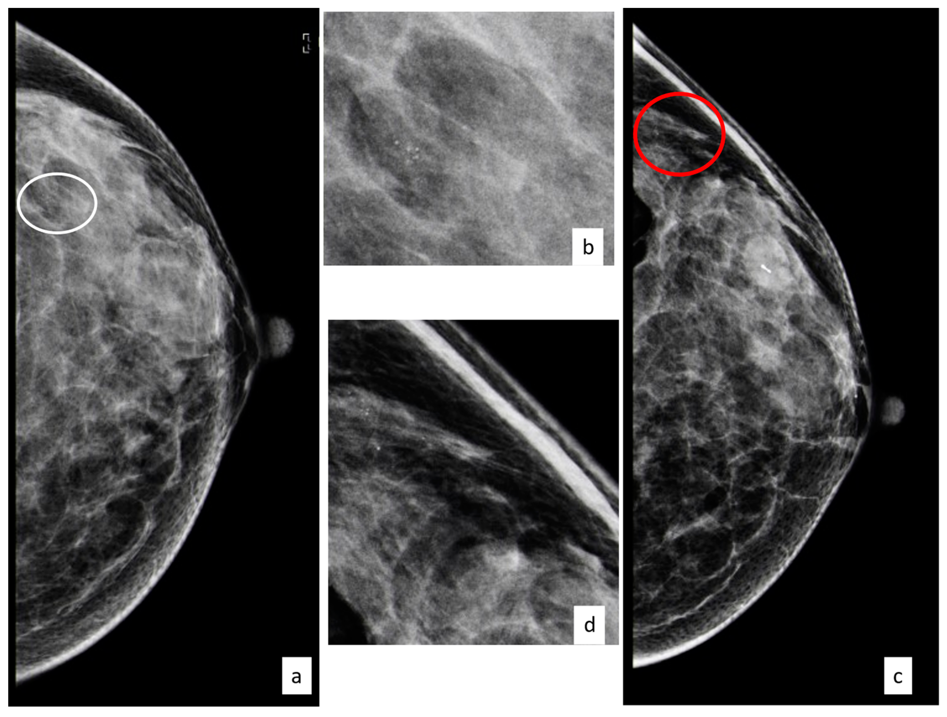 Cancers Free Full-Text Breast Lesions of Uncertain Malignant Potential (B3) and the Risk of Breast Cancer Development A Long-Term Follow-Up Study picture