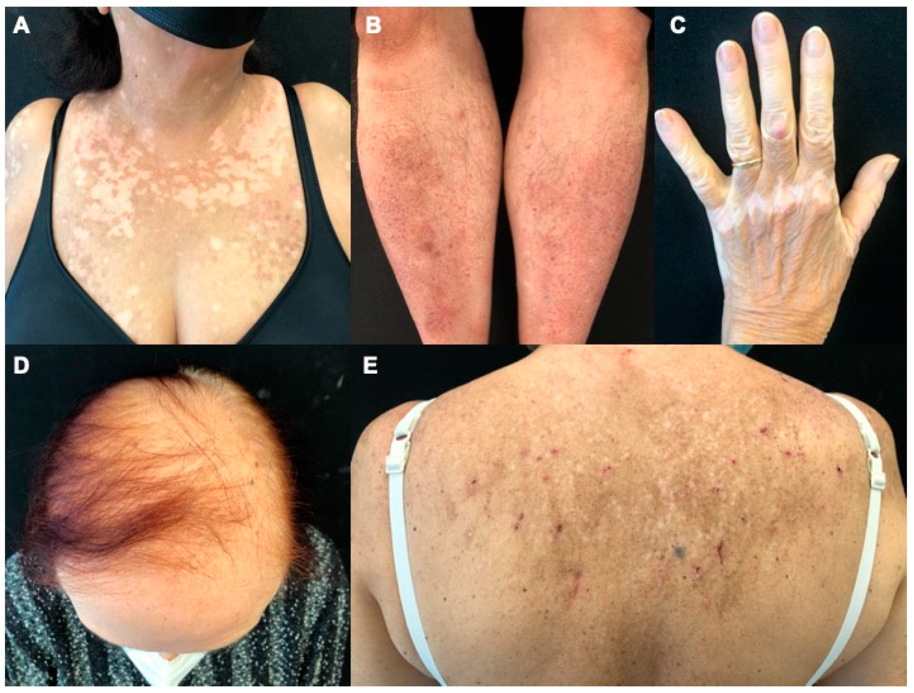 Clinical Challenge: Patchy Rash on Chest - MPR