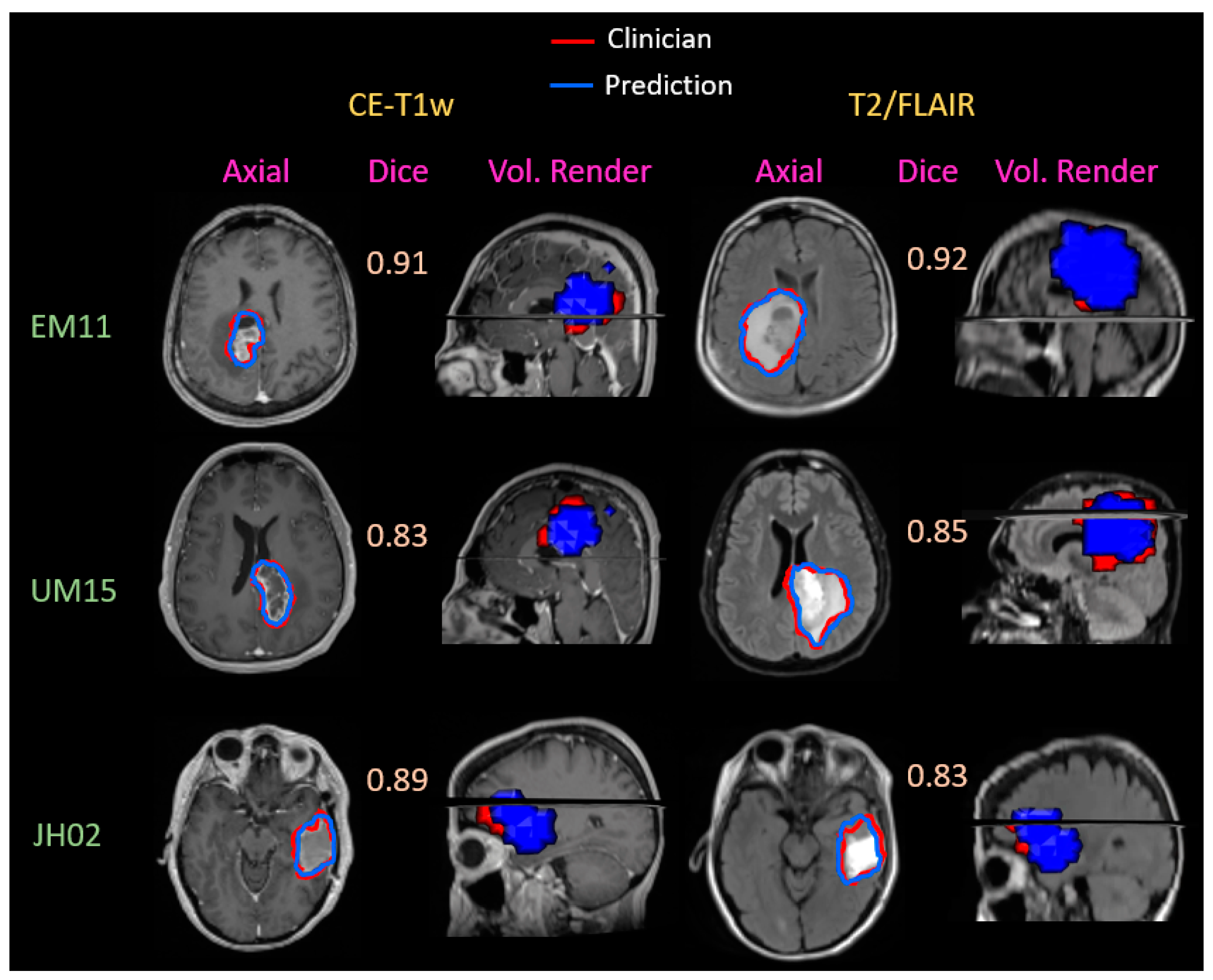 Cancers | Free Full-Text | A Fully Automated Post-Surgical Brain Tumor ...