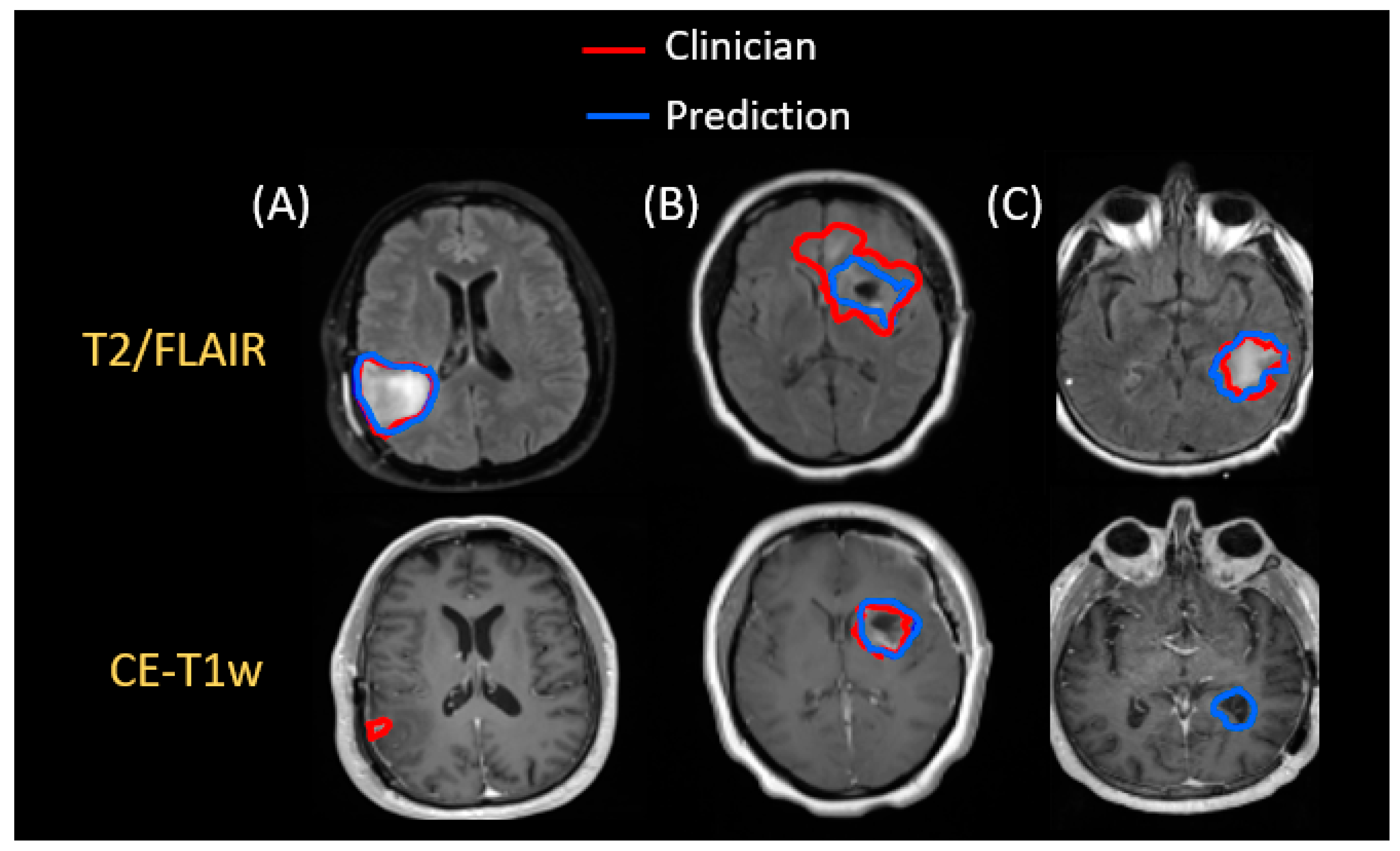 Cancers | Free Full-Text | A Fully Automated Post-Surgical Brain Tumor ...