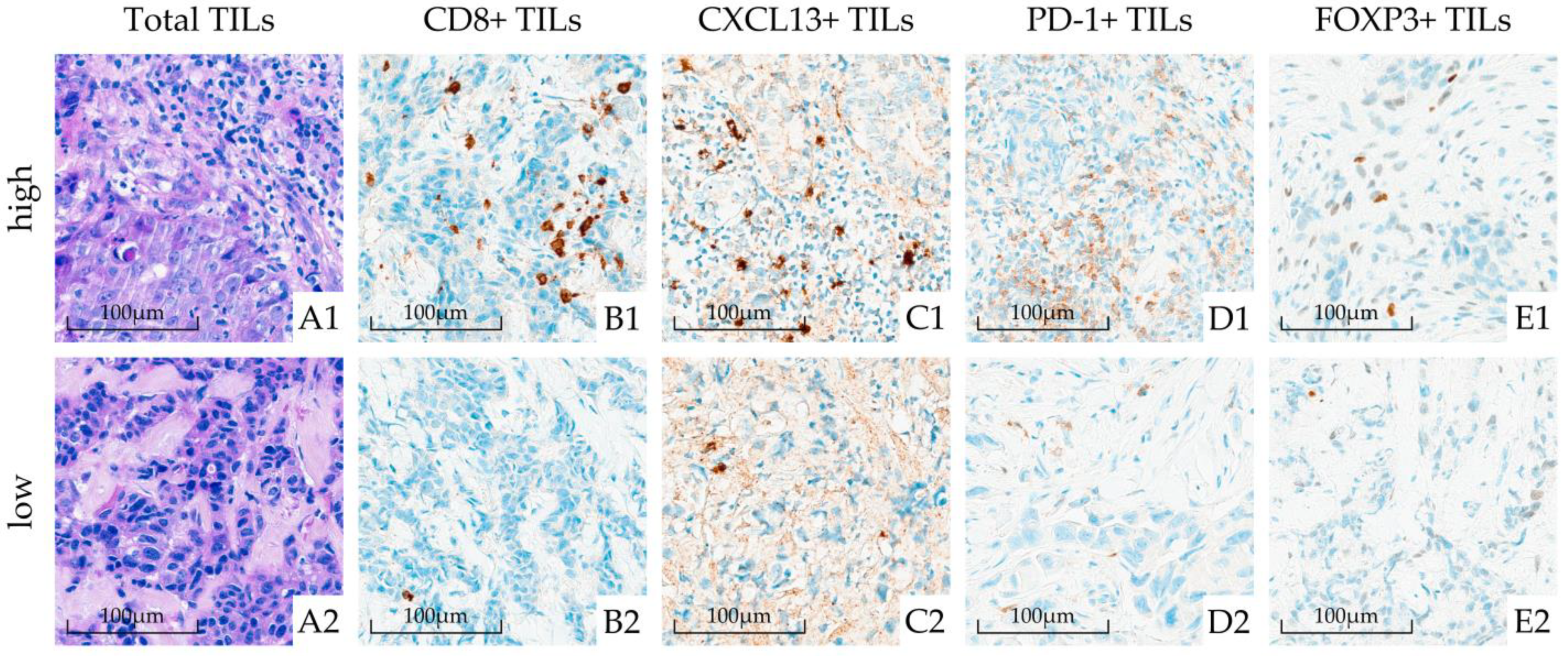 Systemic immune reaction in axillary lymph nodes adds to tumor-infiltrating  lymphocytes in triple-negative breast cancer prognostication