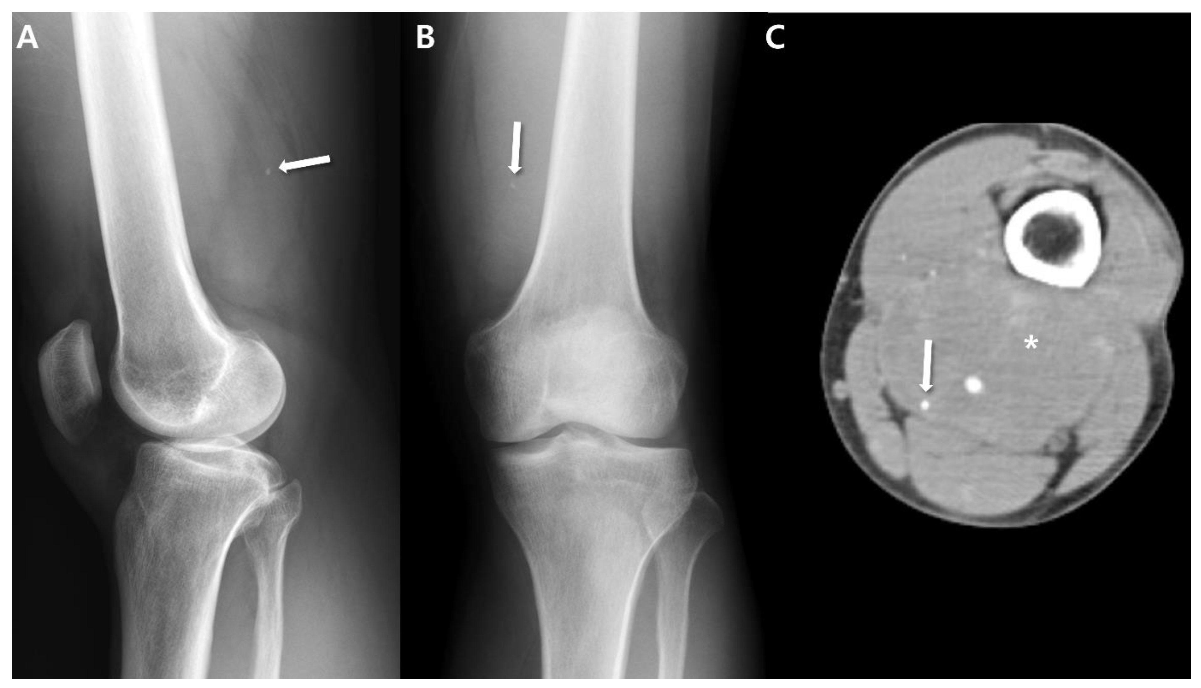 Synovial Sarcoma In The Extremity Diversity Of Imaging Features For Synovial Sarcoma In The Extremity Diversity Of Imaging Features For