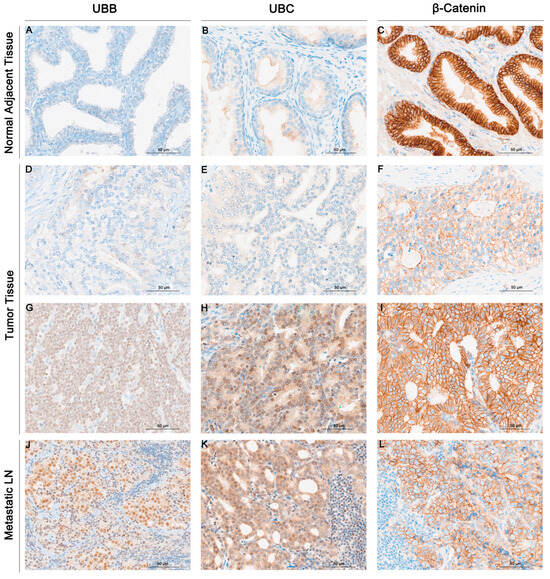 Cancers | Free Full-Text | Ubiquitin B, Ubiquitin C, And β-Catenin As ...