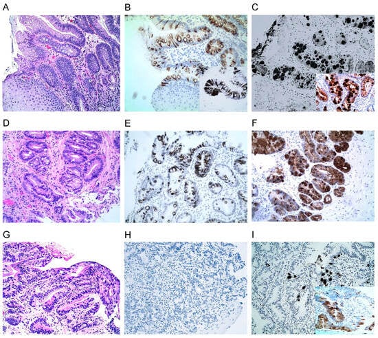 Cancers | Free Full-Text | The Aberrant Expression of Biomarkers and ...