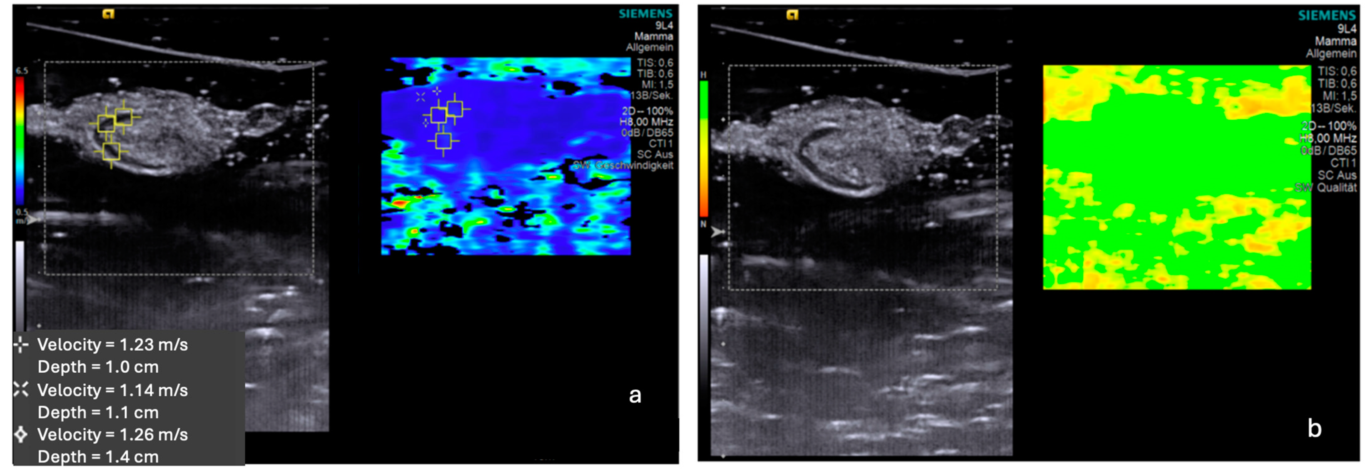Evaluation Of Ex Vivo Shear Wave Elastography Of Axillary Sentinel Evaluation Of Ex Vivo Shear Wave Elastography Of Axillary Sentinel
