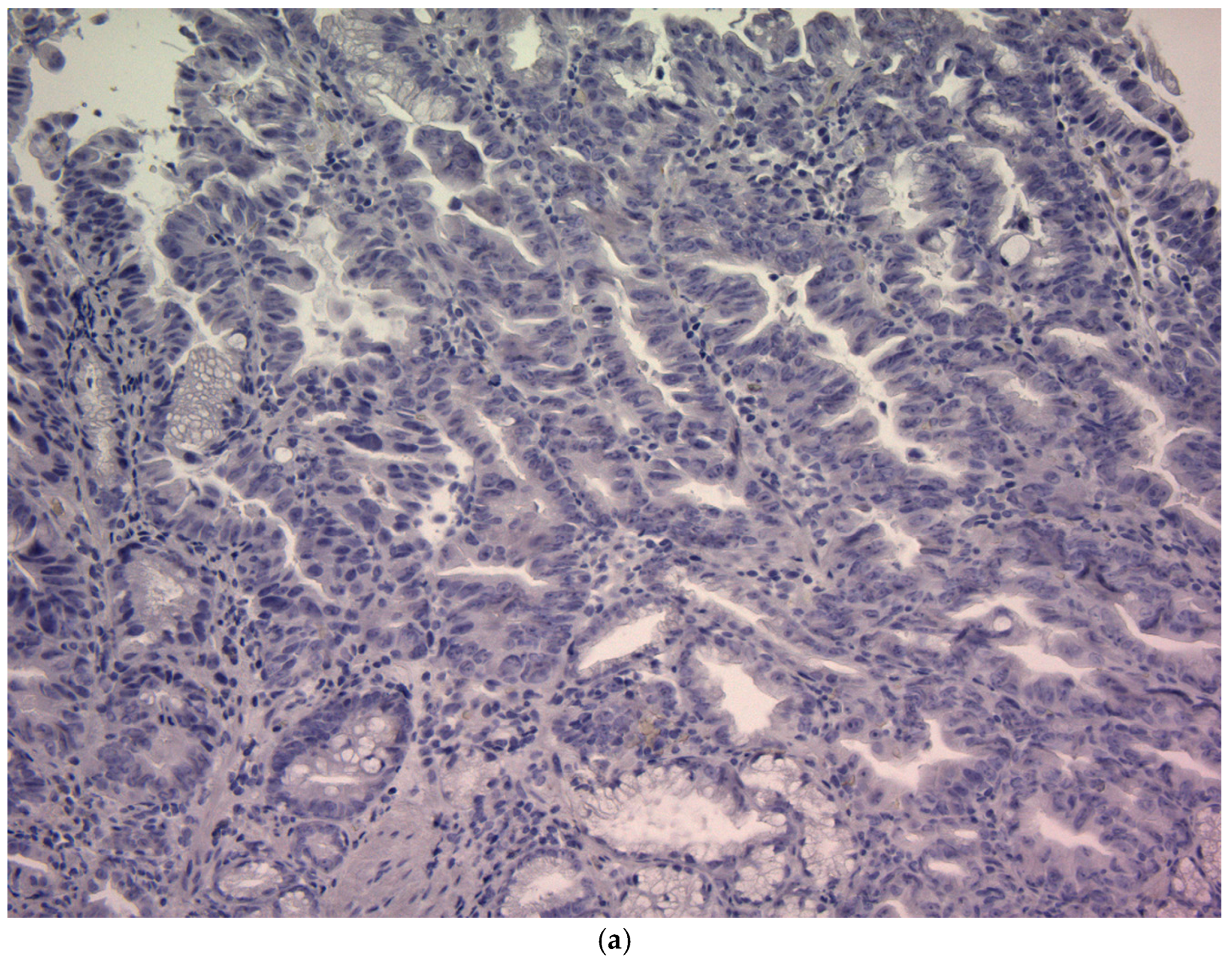 CD44v9 Expression in Pretreatment Biopsies as a Predictor of