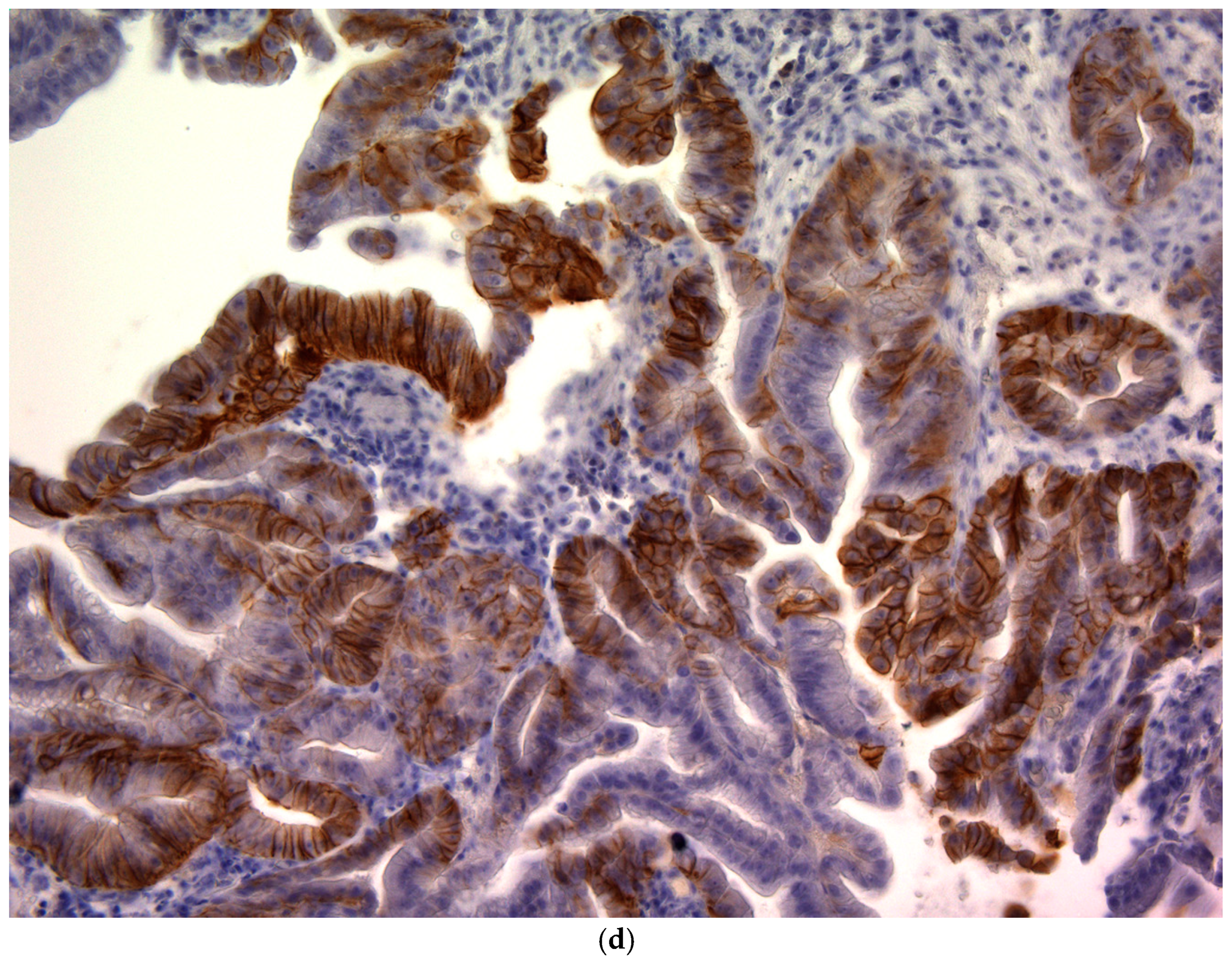 CD44v9 Expression in Pretreatment Biopsies as a Predictor of