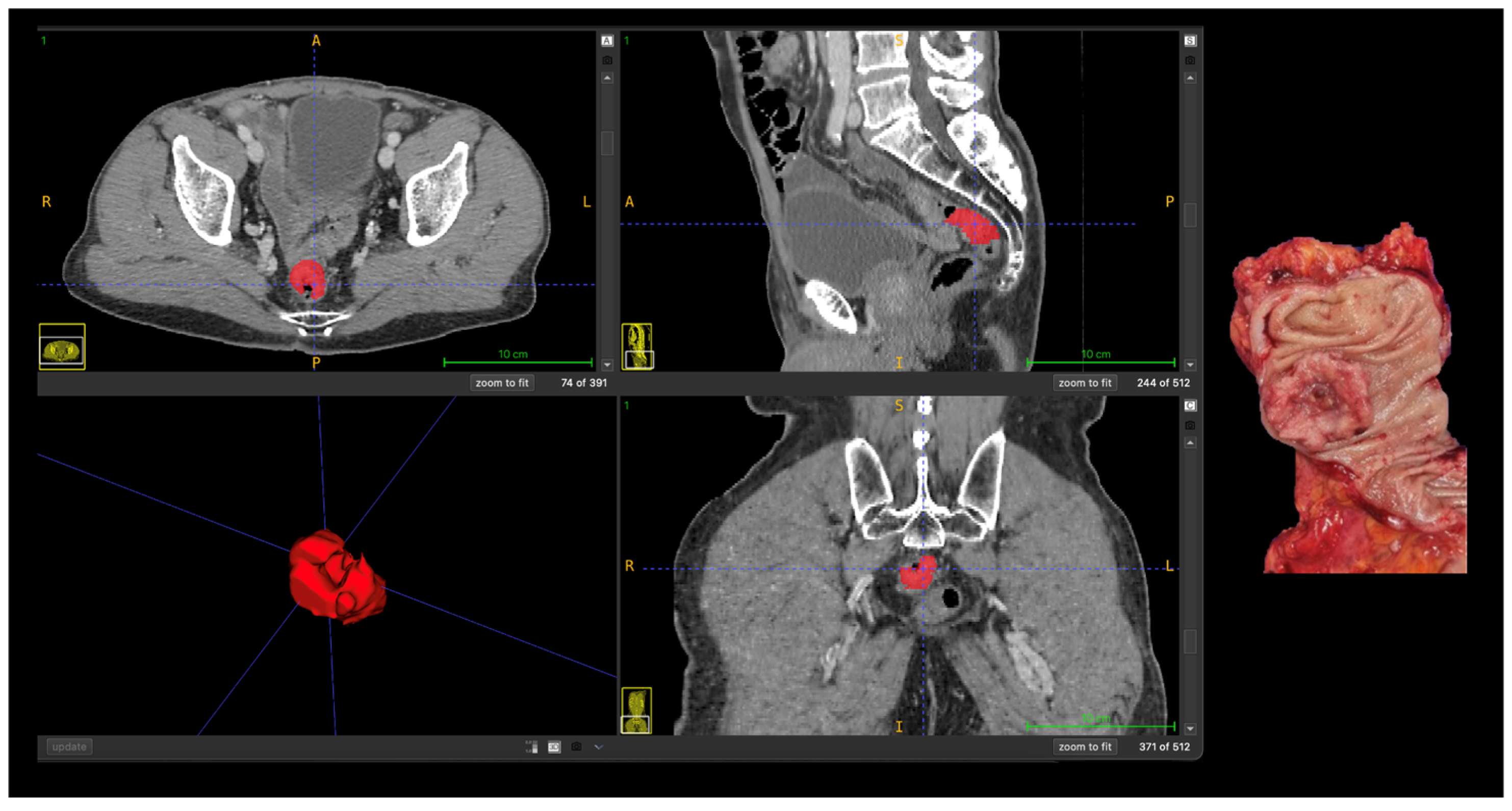 Machine Learning Radiomics in Computed Tomography for Prediction of ...