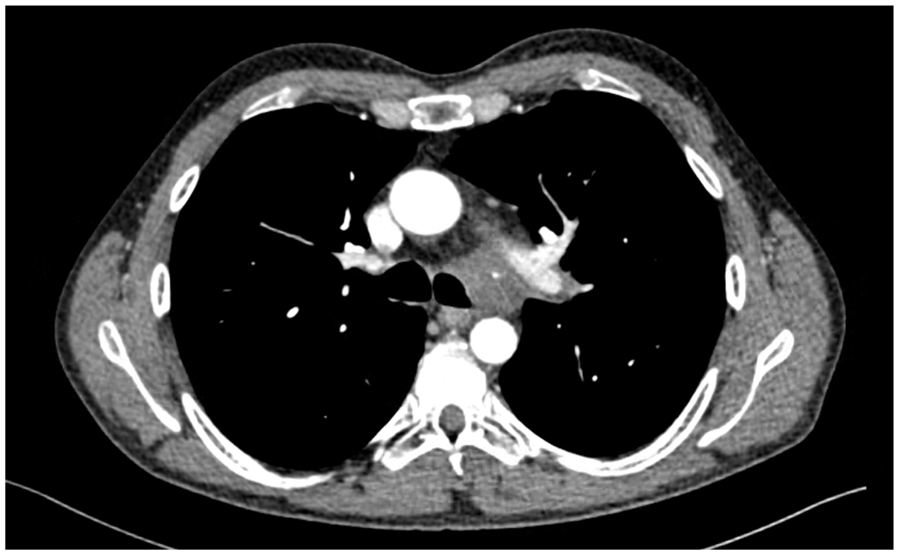 Technical Options and Airway Management in Carinal Resections