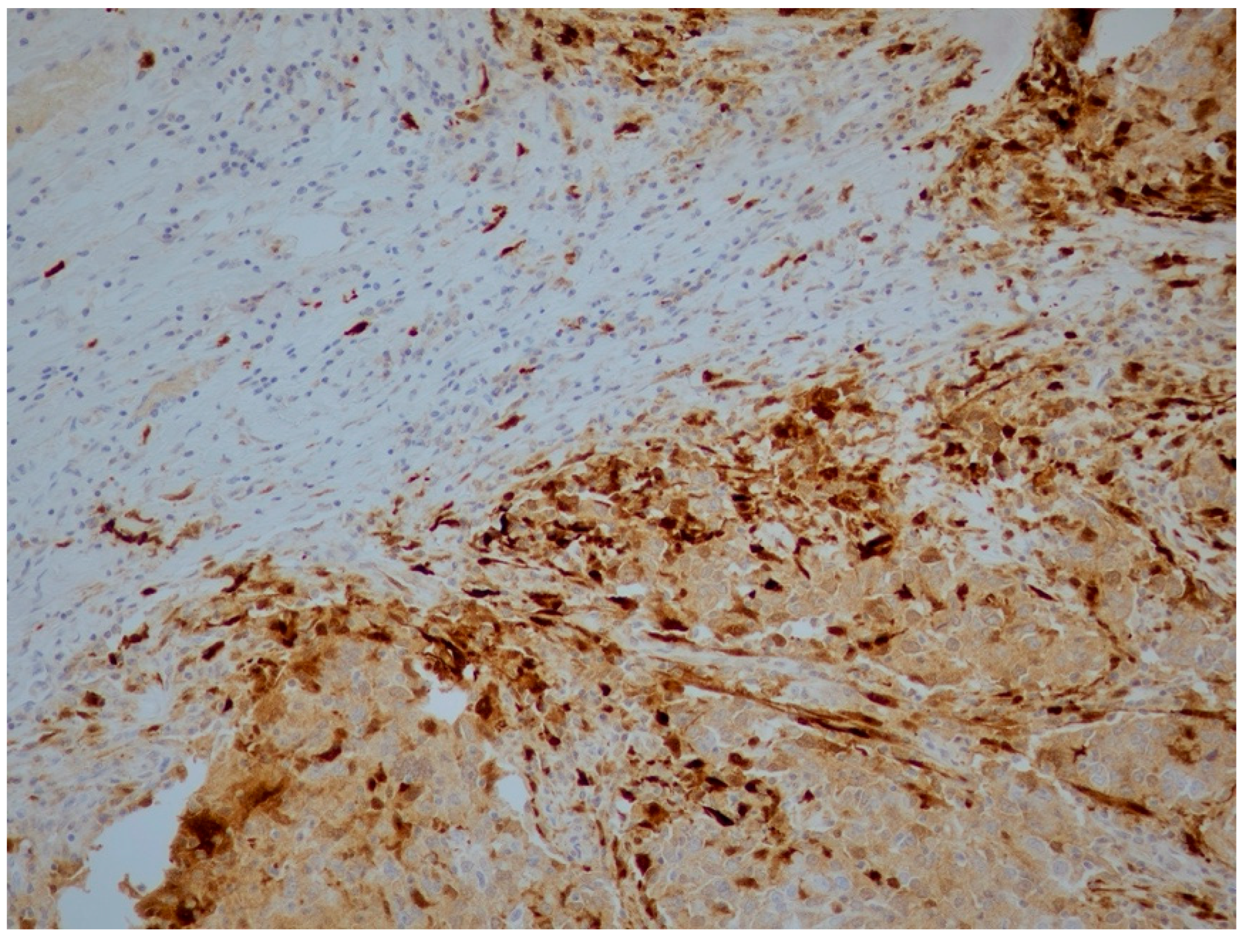 Immunohistochemical Expression of IDO and PD-L1 in Distinct ...