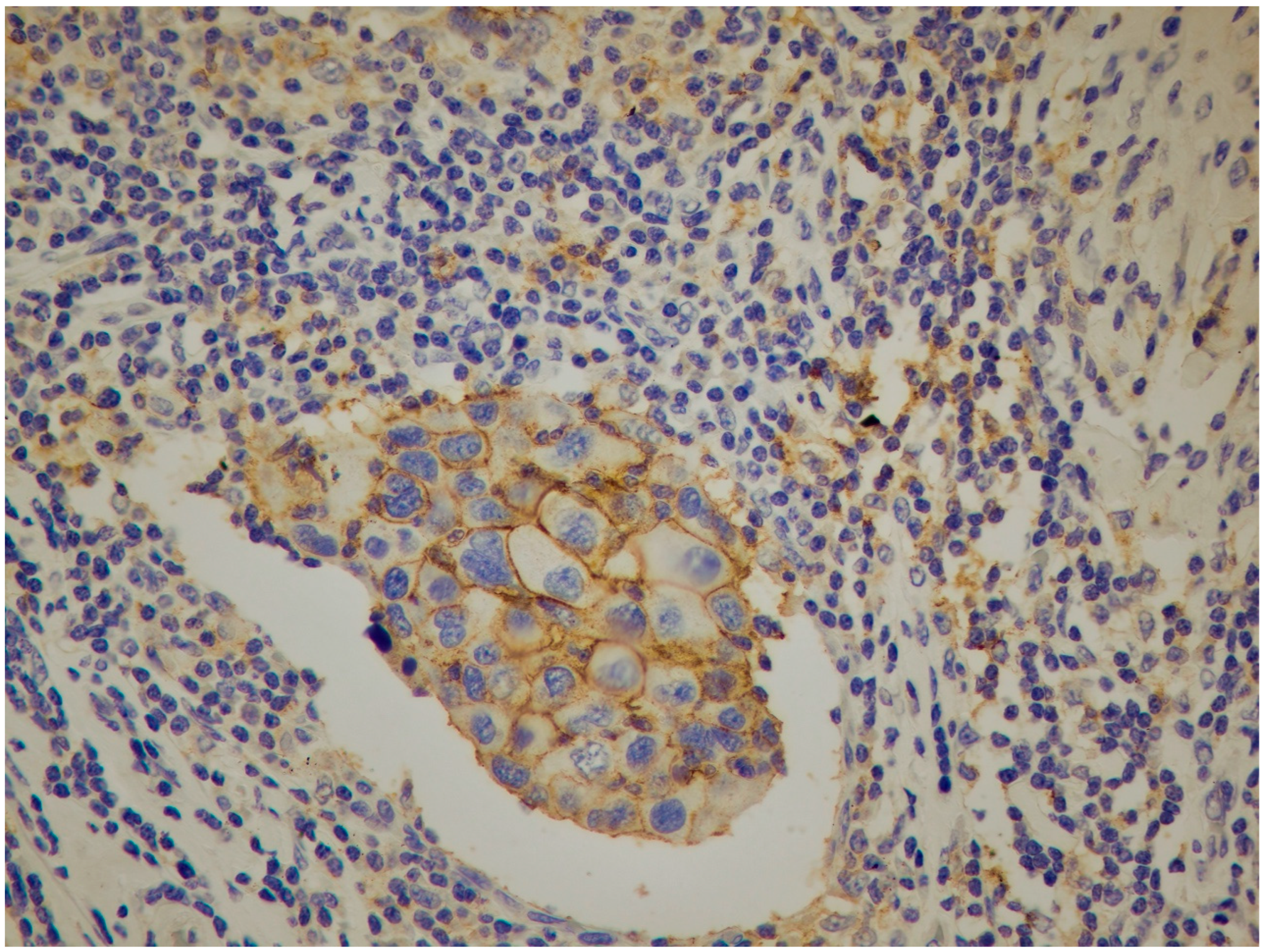 Immunohistochemical Expression of IDO and PD-L1 in Distinct ...