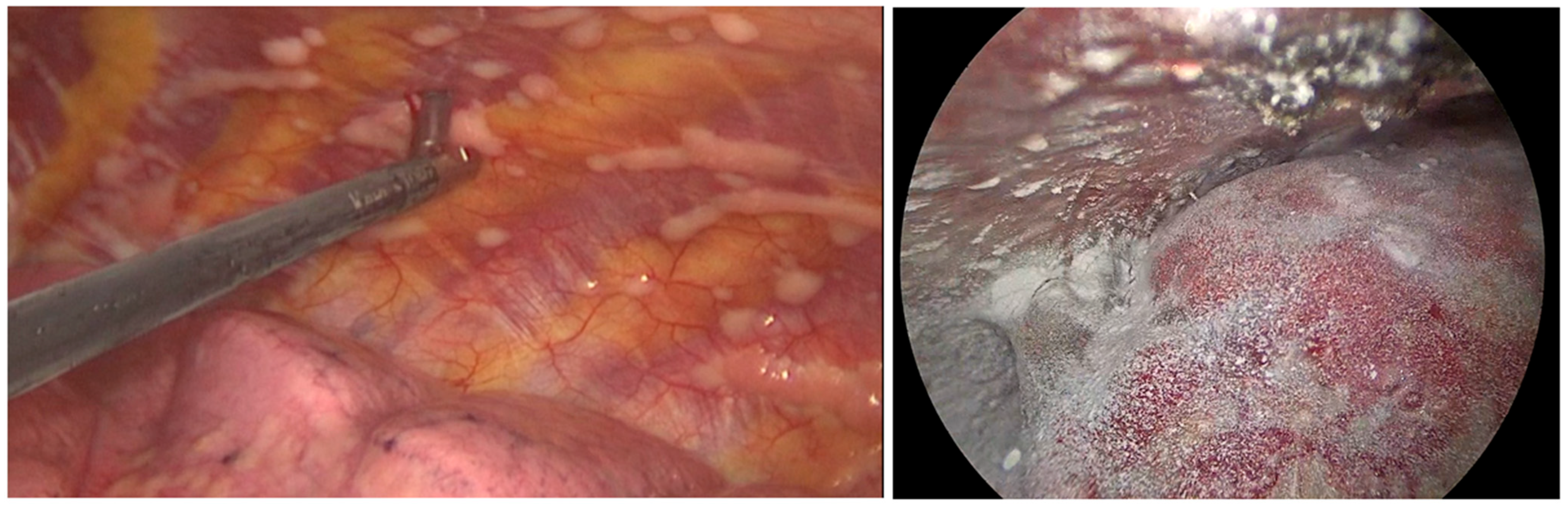 Vats Using Talc Safety and Efficacy of Single-Stage Synchronous Bilateral VATS Talc ...