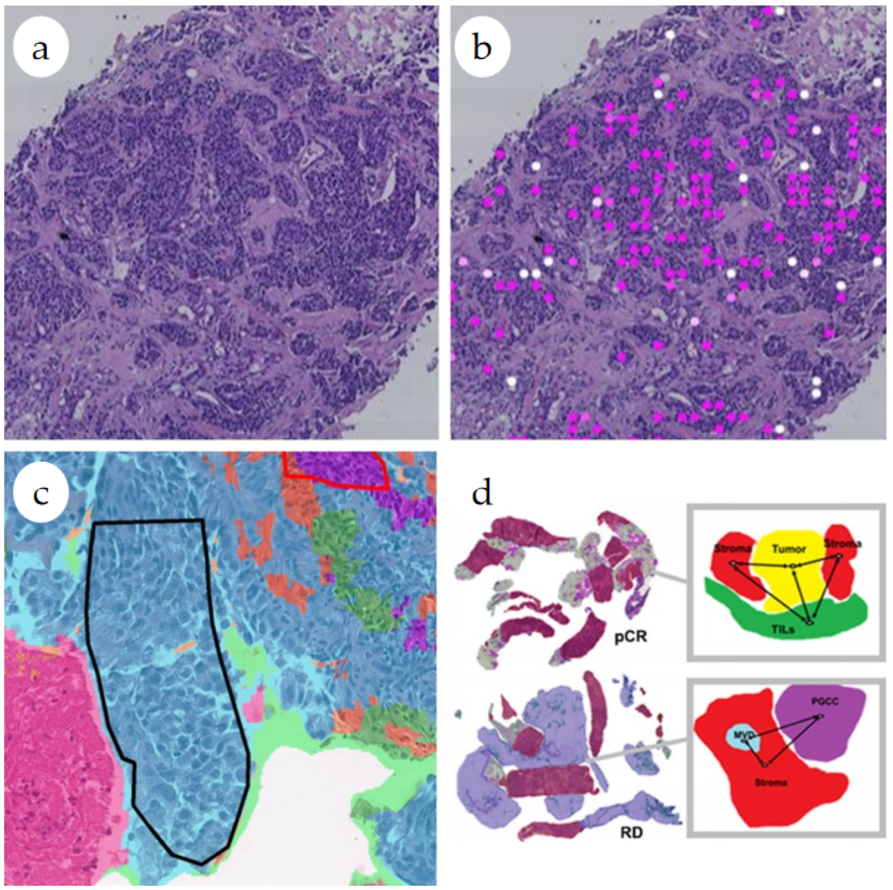 Computer Vision for Predicting the Efficacy of Neoadjuvant Therapy in ...