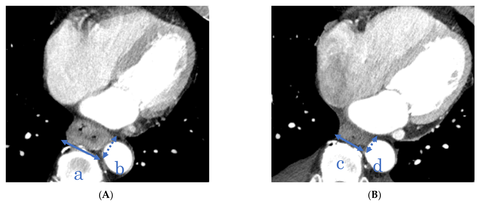 Two-Dimensional CT Tumor Measurement Predicts Pathological Response and ...