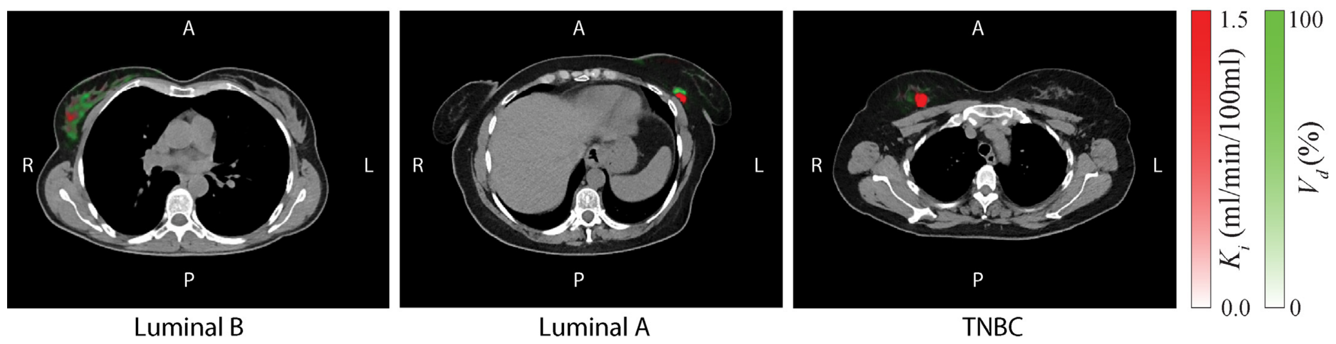 Subtype-Specific Metabolic Patterns in Staging Breast Cancer: Insights ...