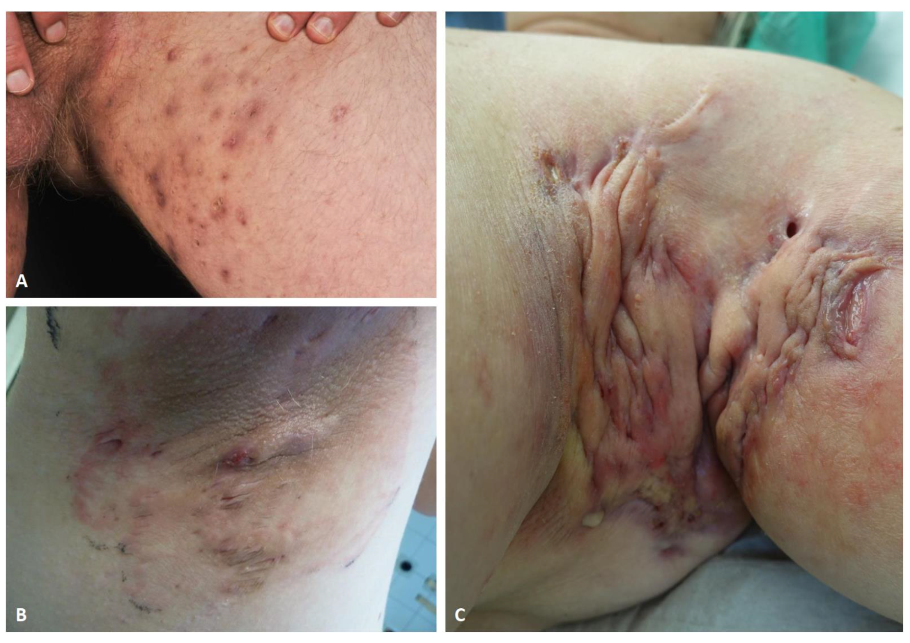 Hidradenitis Suppurativa Scars Reference Pictures