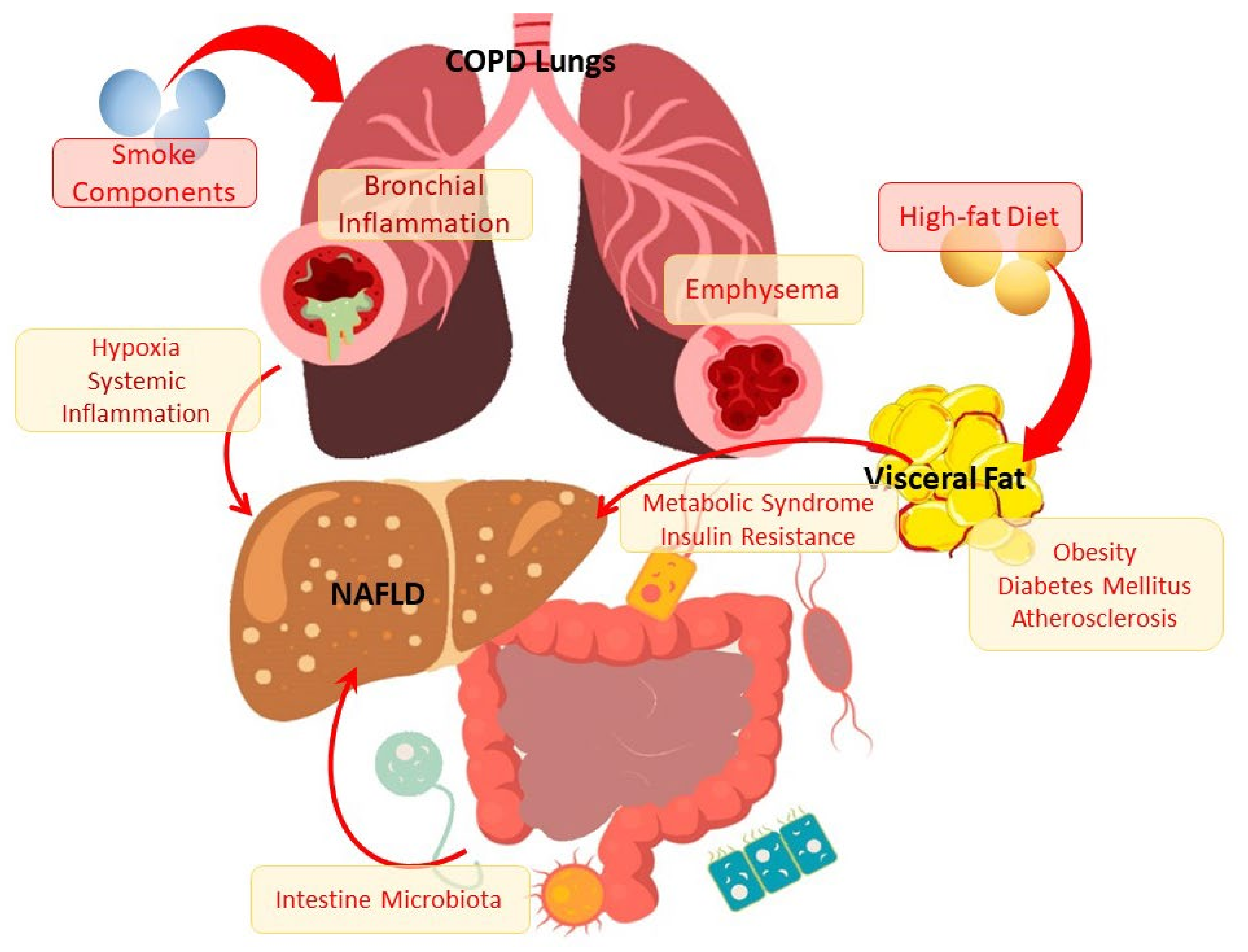 Cells | Free Full-Text | Lipid Metabolism Disorders in the Comorbid Course  of Nonalcoholic Fatty Liver Disease and Chronic Obstructive Pulmonary  Disease
