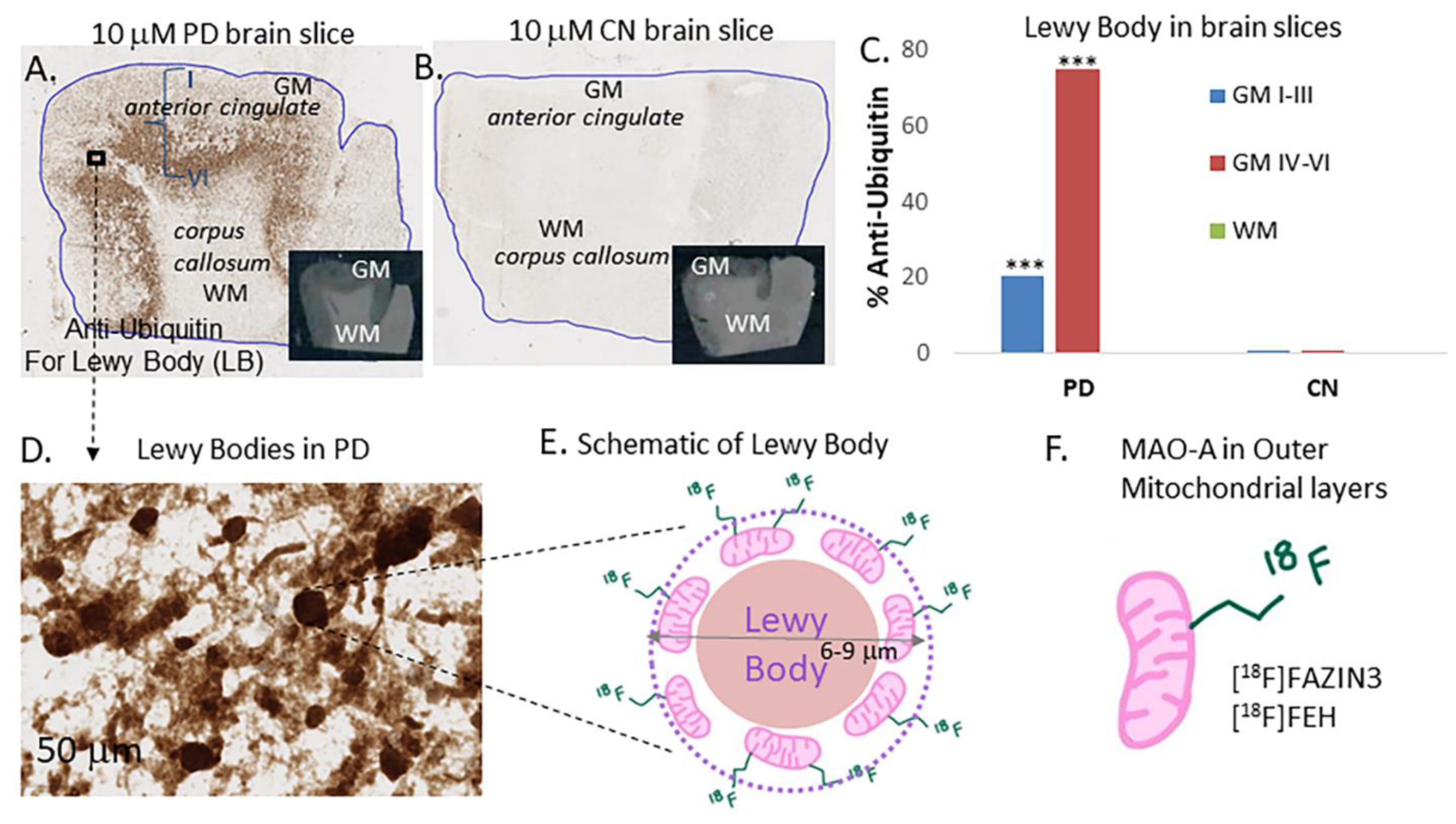 A schematic model of Lewy body formation