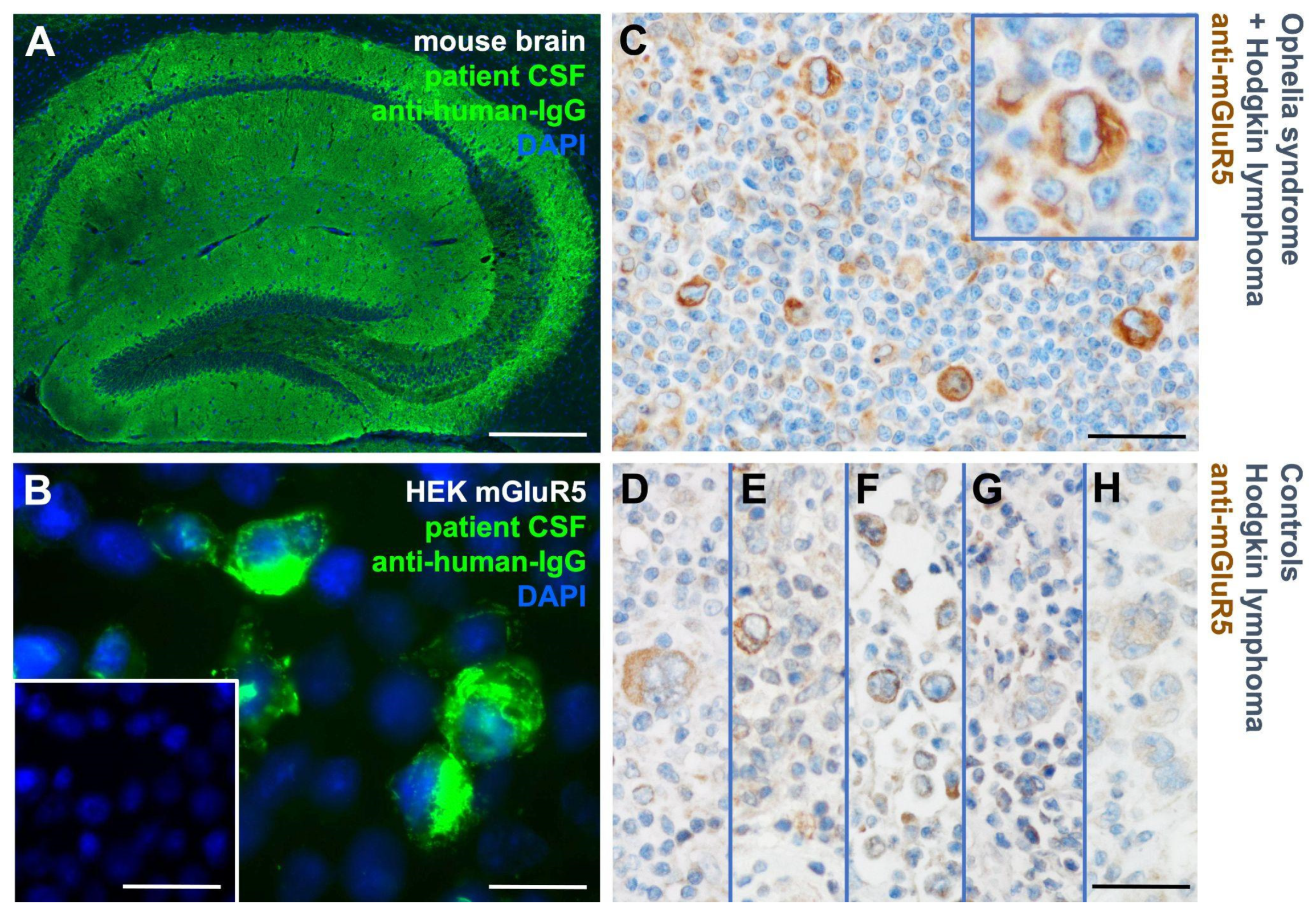 Cells Free Full-Text Hodgkin Lymphoma Cell Lines and Tissues Express mGluR5 A Potential Link to Ophelia Syndrome and Paraneoplastic Neurological Disease