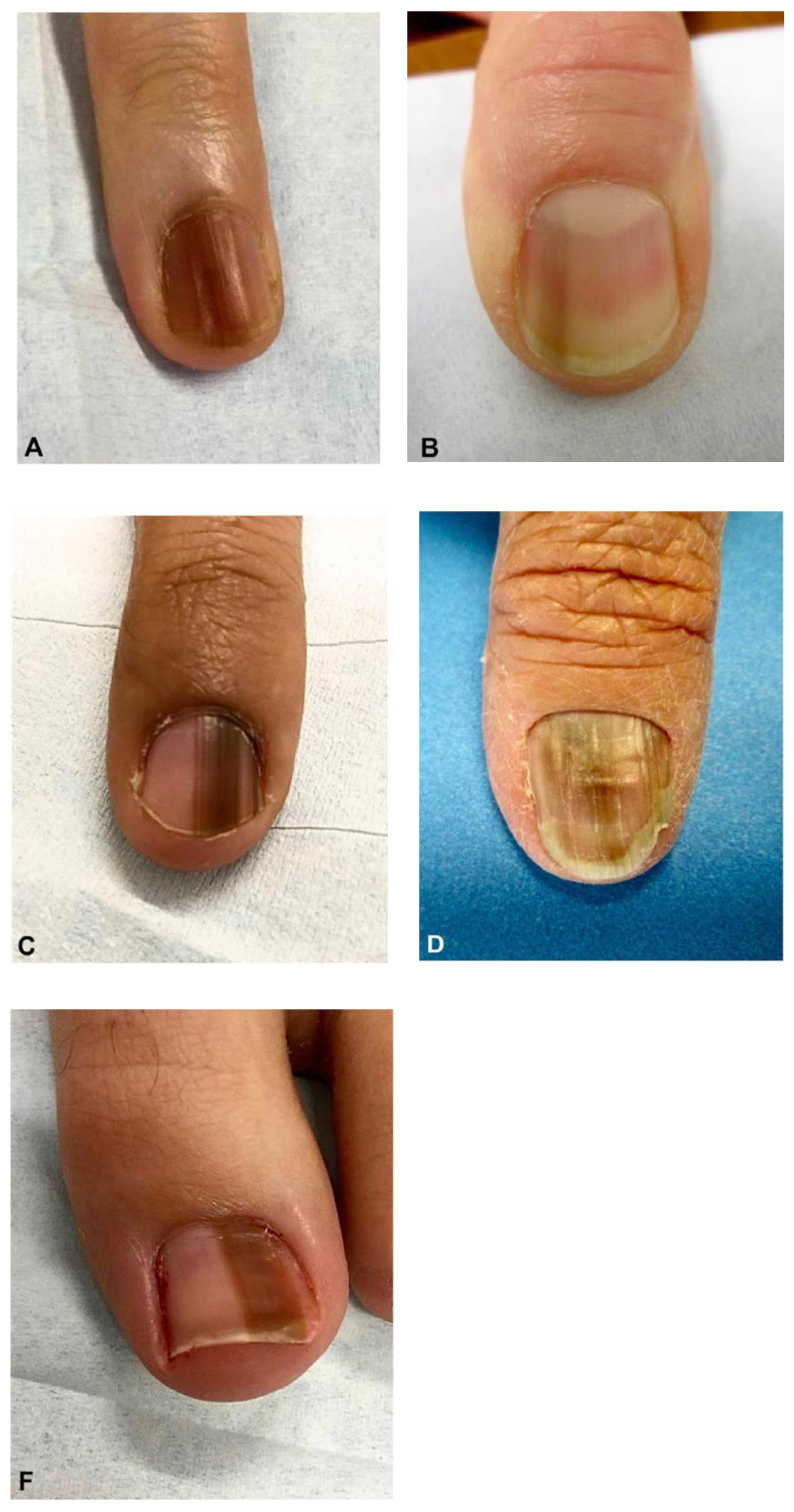 Figure 3 from Clinicopathologic features of 28 cases of nail matrix nevi  (NMNs) in Asians: Comparison between children and adults | Semantic Scholar