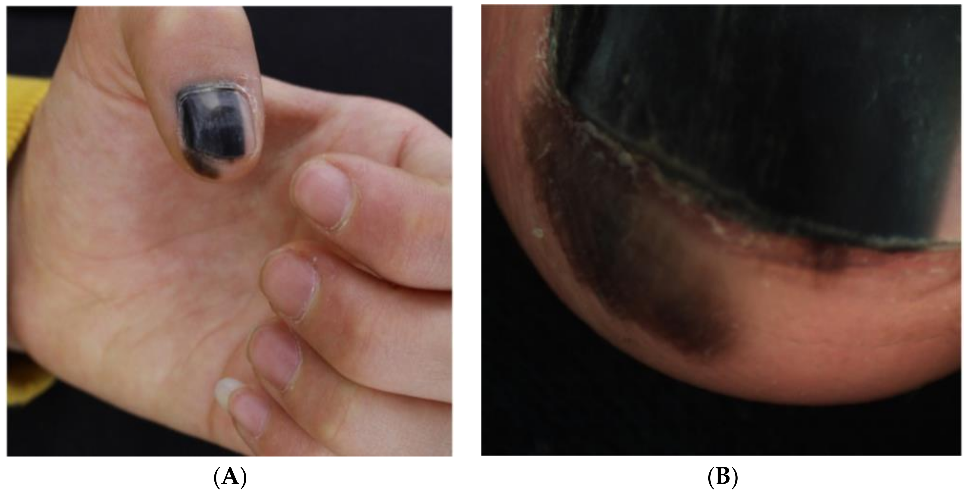 Congenital subungual melanocytic nevus with a pseudo-Hutchinson sign