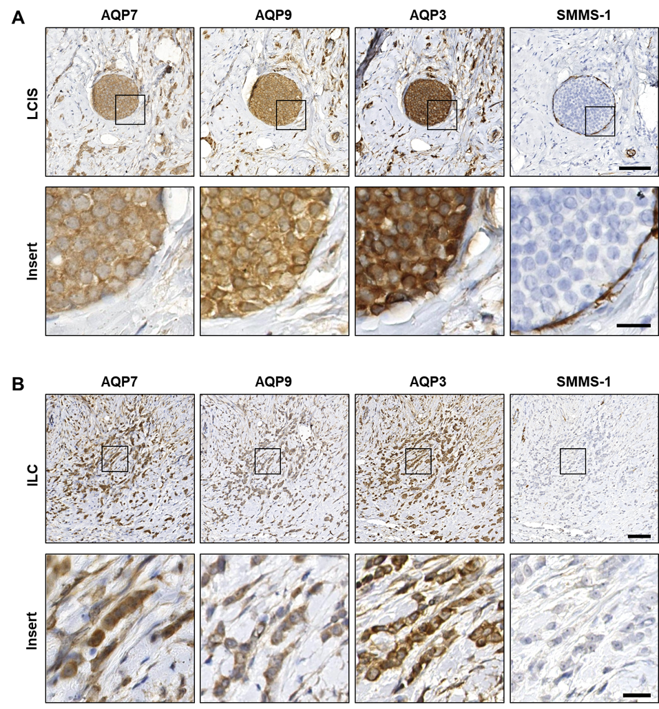 cells-free-full-text-aquaglyceroporins-in-human-breast-cancer