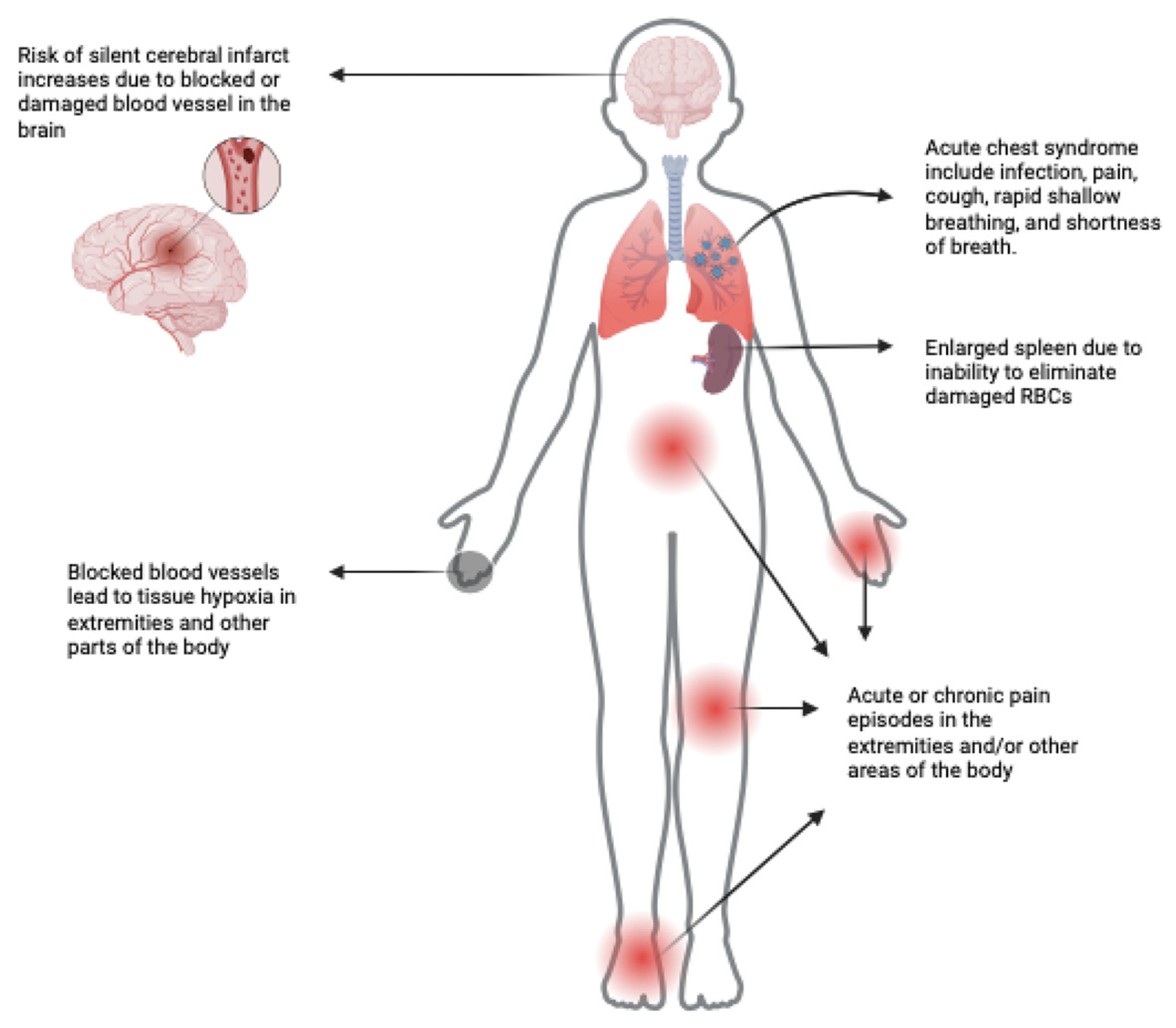 What Is Sickle Cell Disease Symptoms Causes And Risk Factors Health What Is Sickle Cell Disease Symptoms Causes And Risk Factors Health